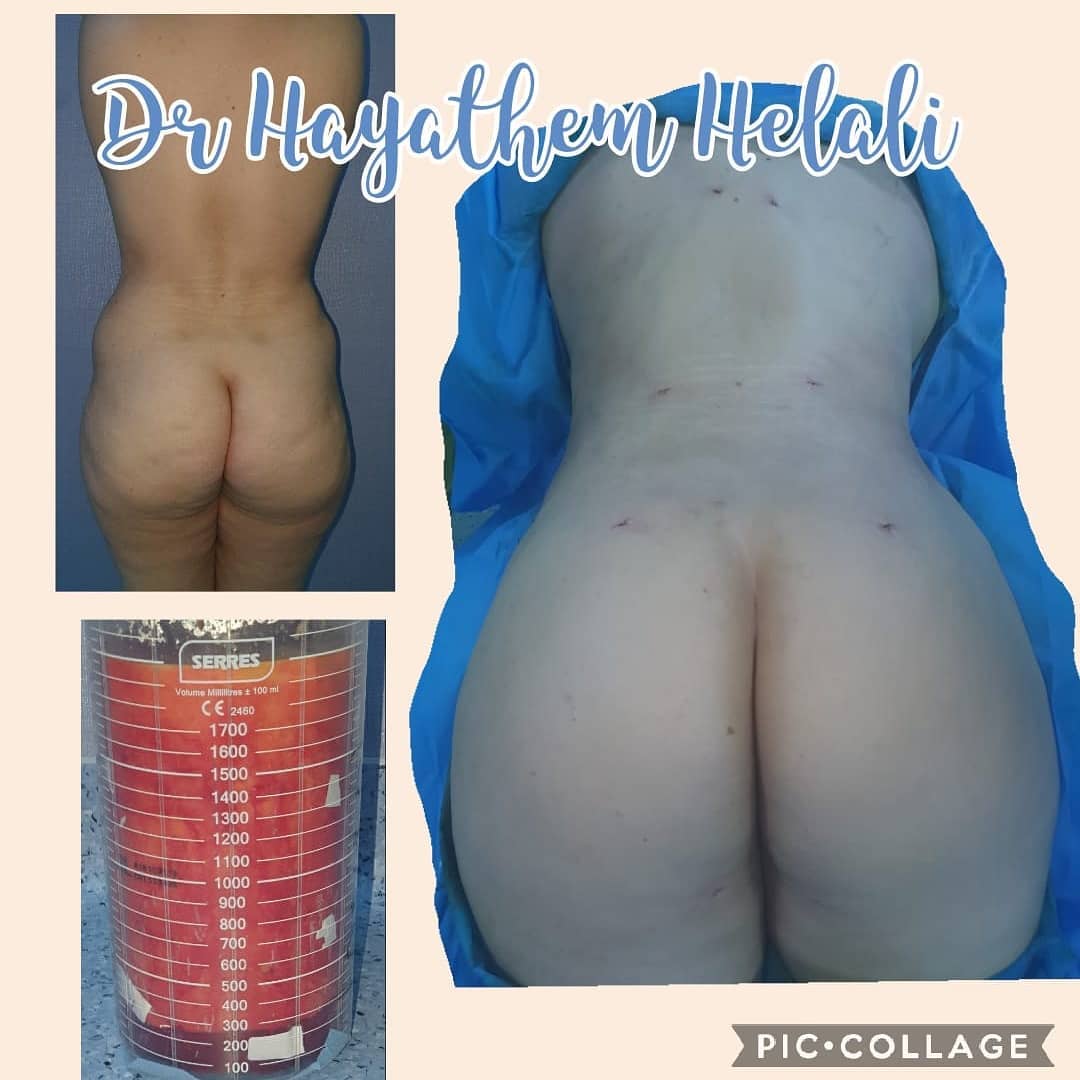 Un avant/après d'une augmentation des fesses réalisée par Dr Hayathem Helali.