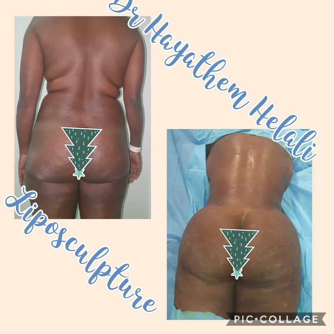 Résultat d'une augmentation des fesses par liposculpture.
