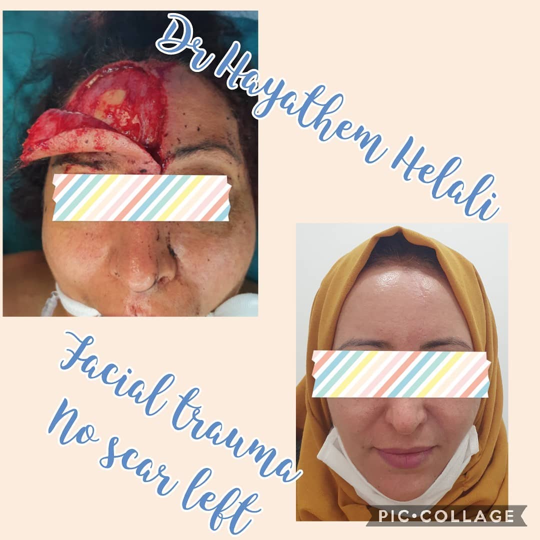 Résultat d'une chirurgie reconstructive après un traumatisme facial due à un accident, présentée deux mois après l'opération.
