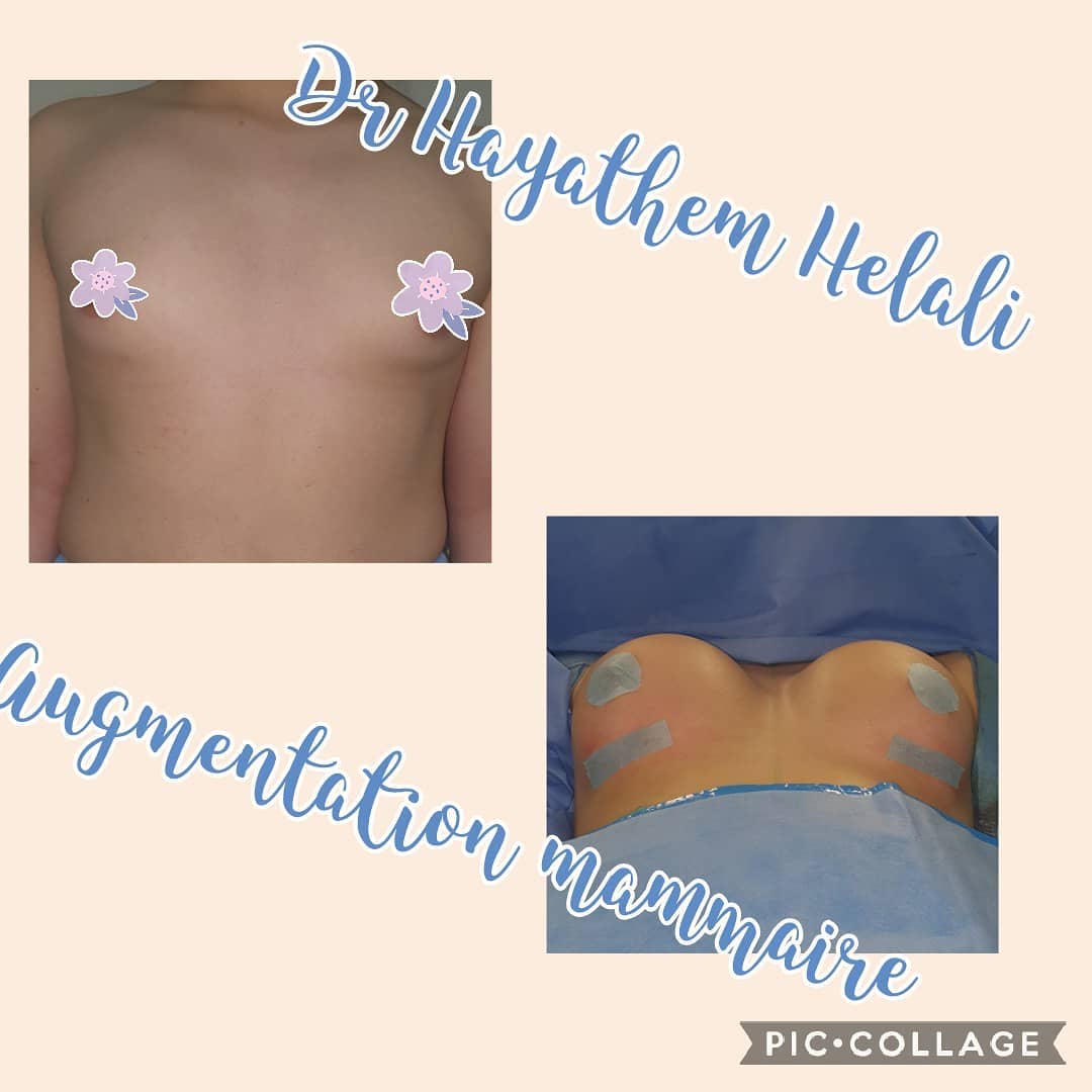 Comparaison avant et après une augmentation mammaire par Dr Hayathem Helali.