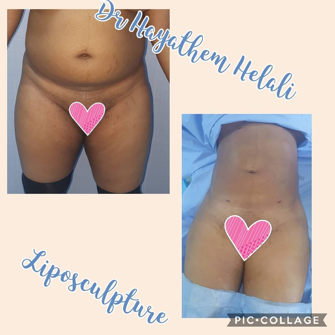Avant et après une augmentation des fesses par liposuccion.