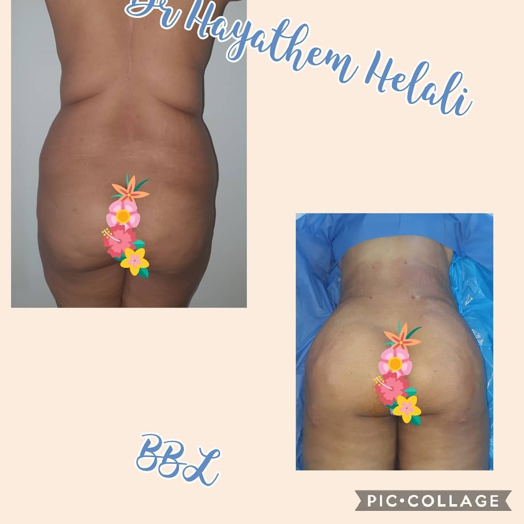 Comparaison avant/après d'une augmentation des fesses.