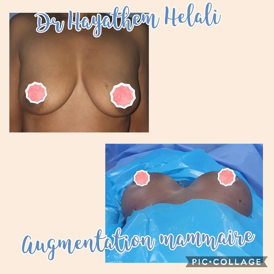 Comparaison avant et après une augmentation mammaire réalisée par Dr Hayathem Helali.
