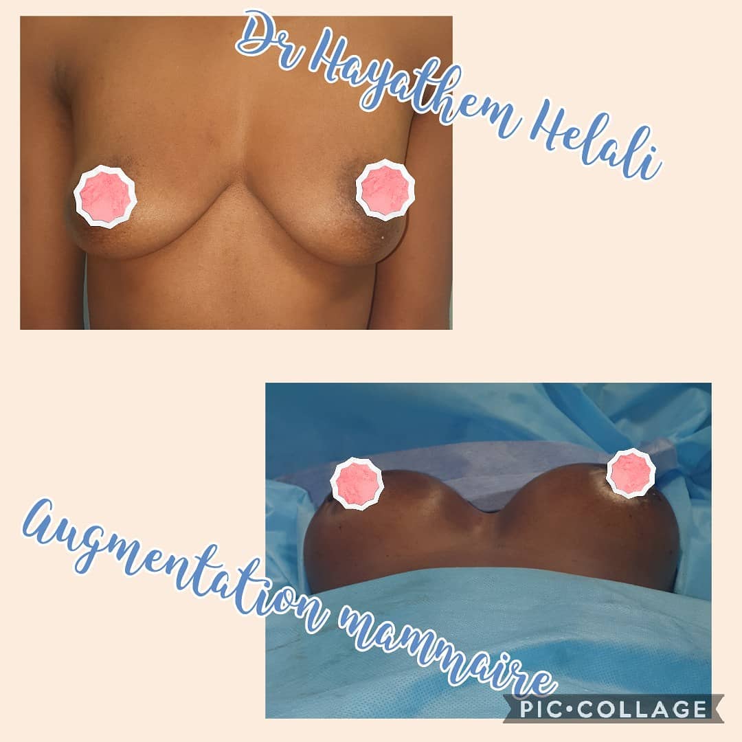 Avant et après une augmentation mammaire réalisée par le Dr Hayathem Helali.