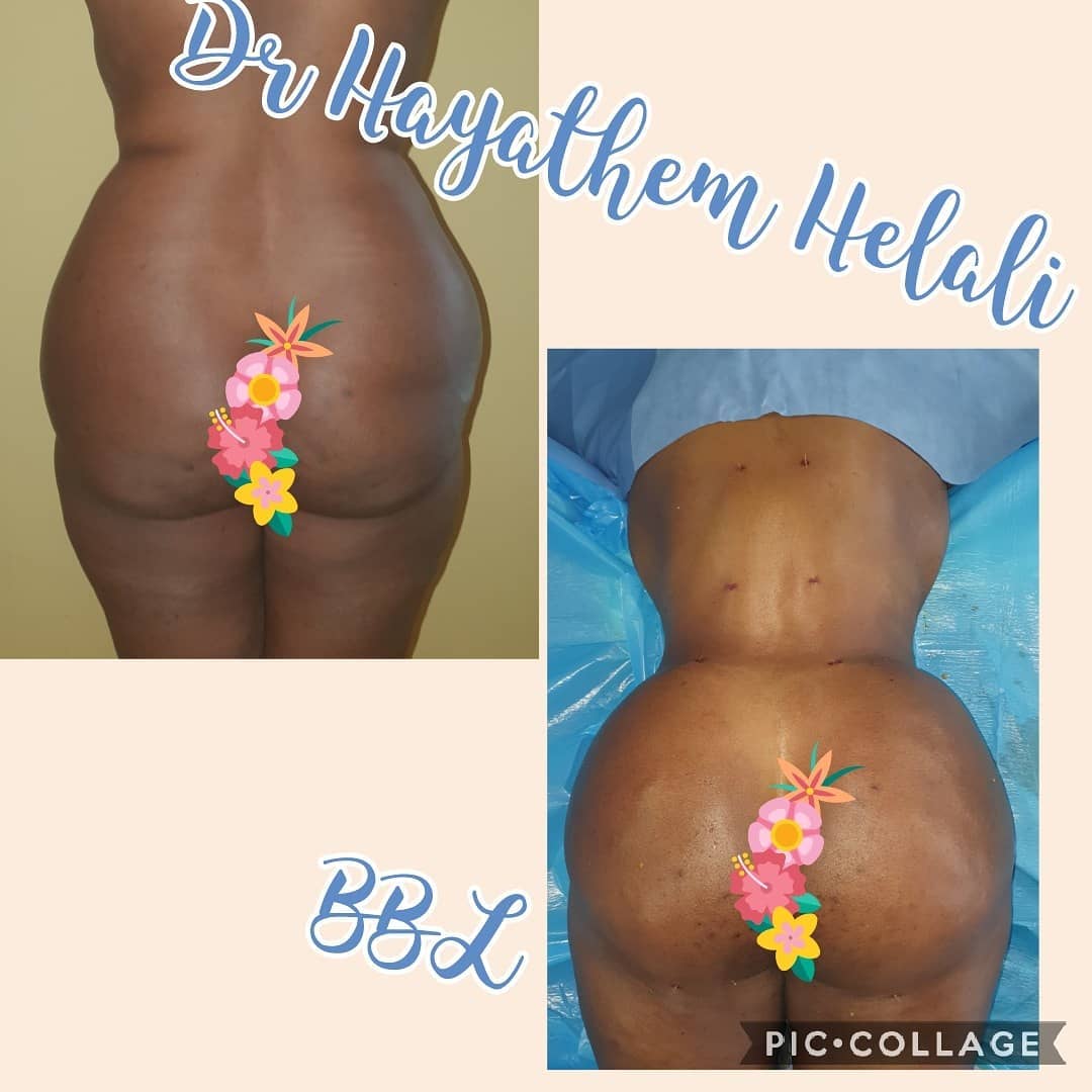 Avant et après une chirurgie d'augmentation des fesses (BBL).