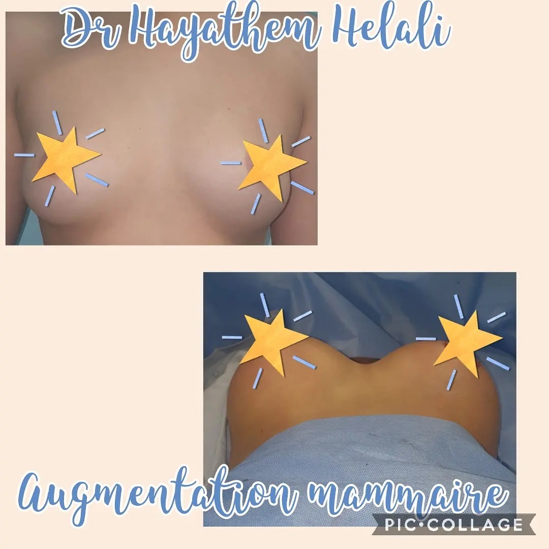 Comparaison avant/après d'une augmentation mammaire réalisée par le Dr Hayathem Helali.