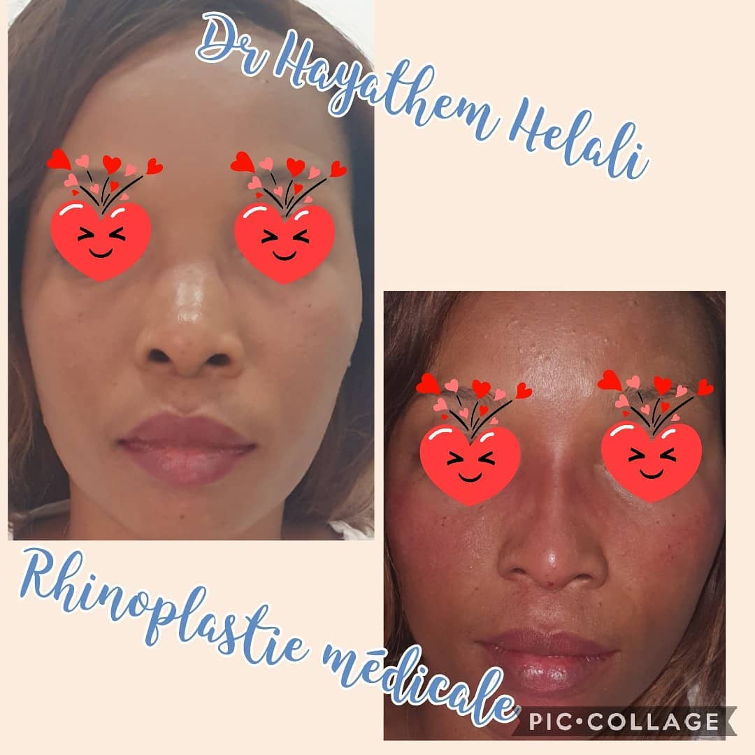 Avant et après une rhinoplastie médicale effectuée par Dr Hayathem Helali.