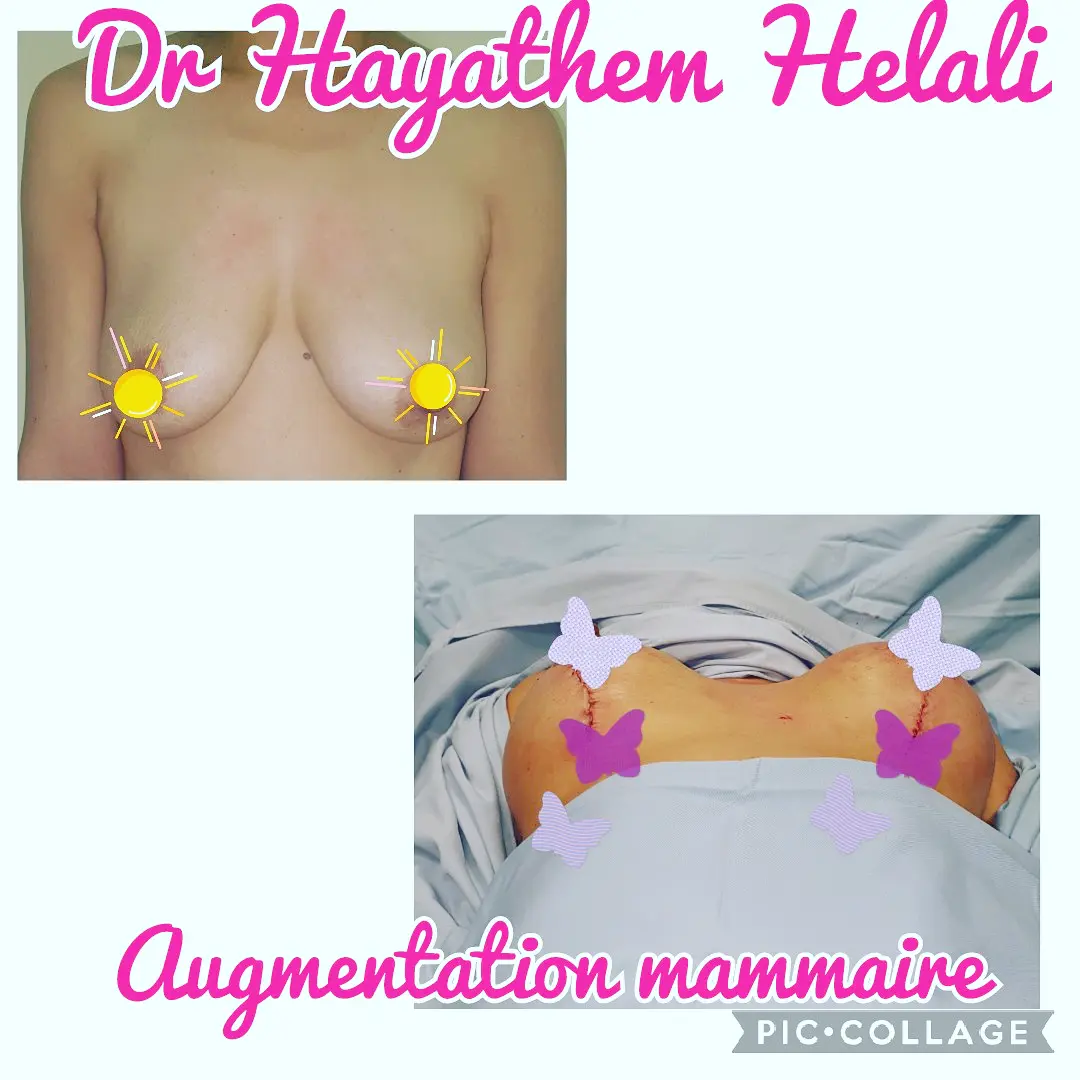 Avant et après une augmentation mammaire réalisée par le Dr Hayathem Helali.