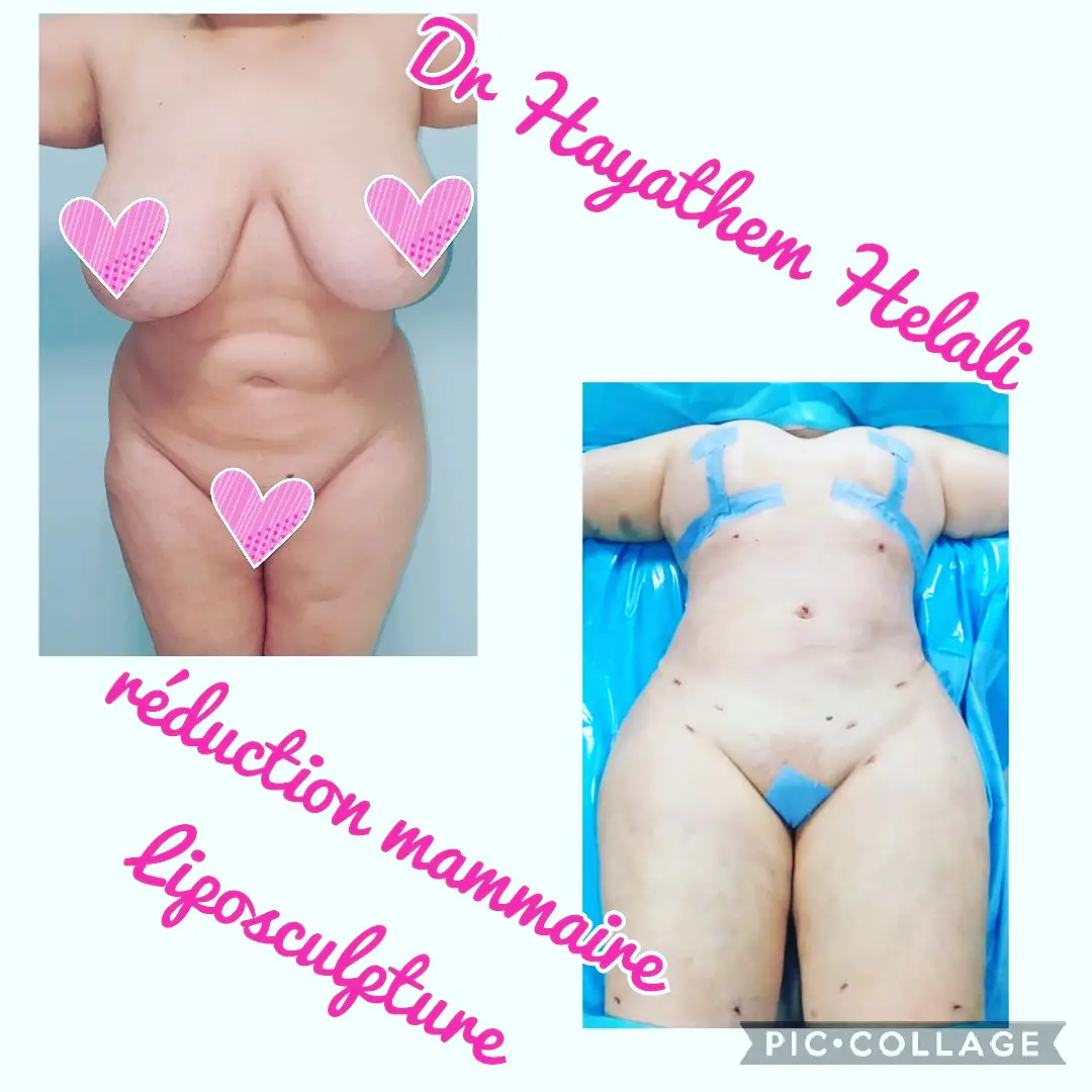 Comparaison avant/après d'une réduction mammaire et liposuccion.