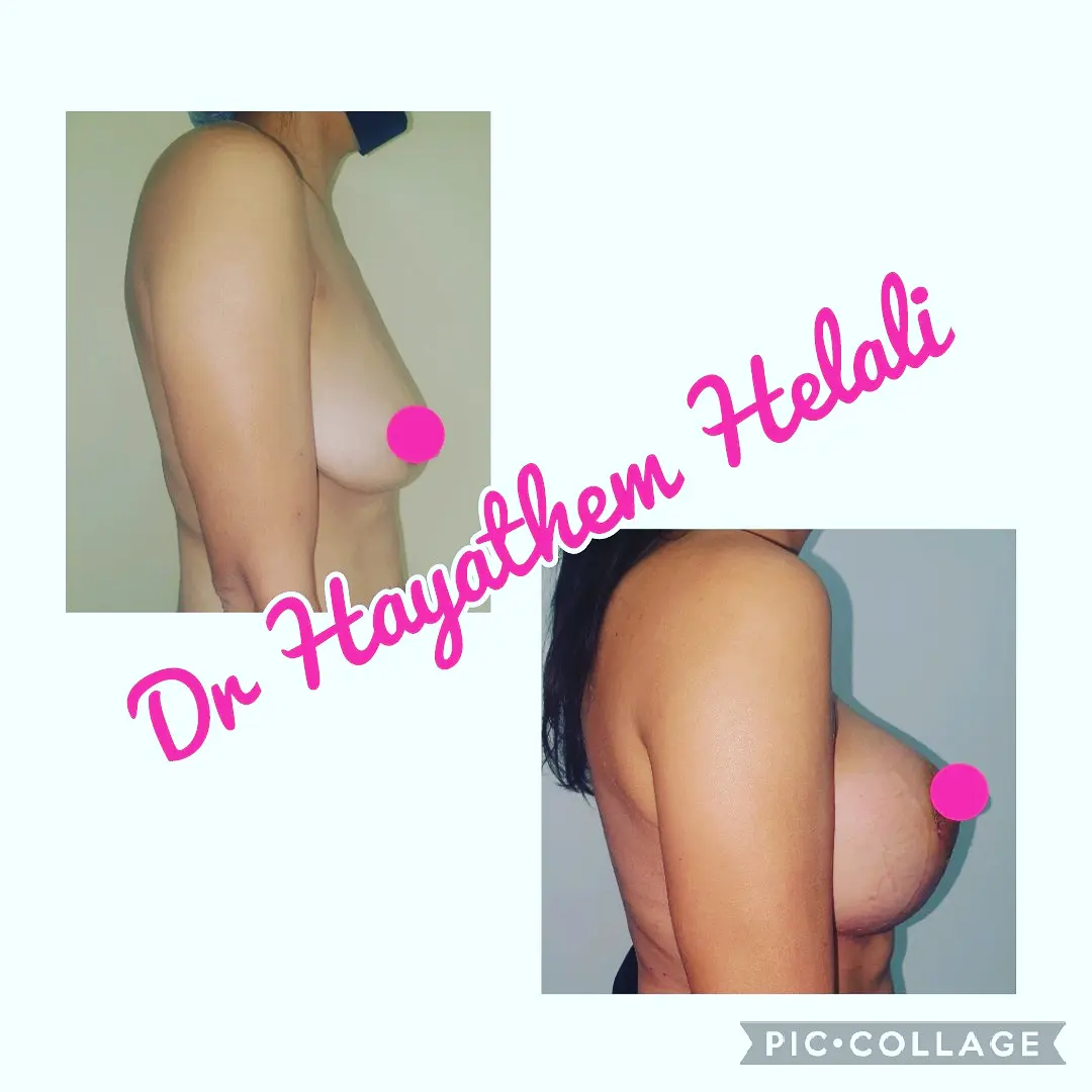 Augmentation mammaire par prothèses rondes à profil extra haut.
