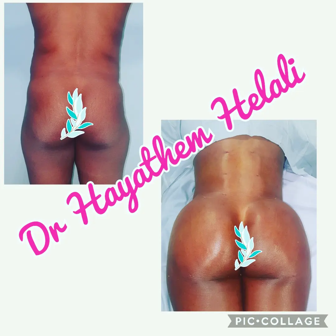 Avant et après une augmentation des fesses par liposculpture.