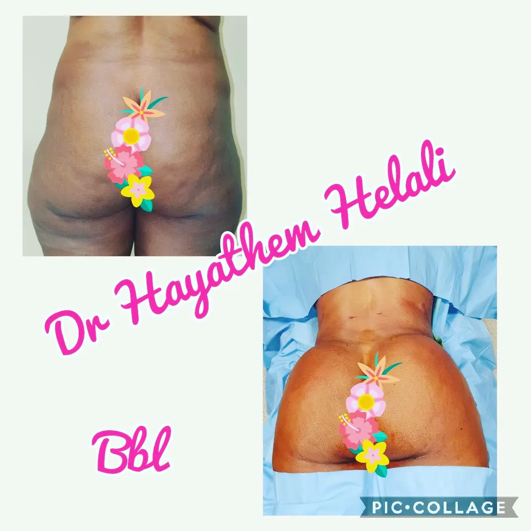 Cette publication montre un avant/après d'une chirurgie BBL réalisée par le Dr Hayathem Helali.