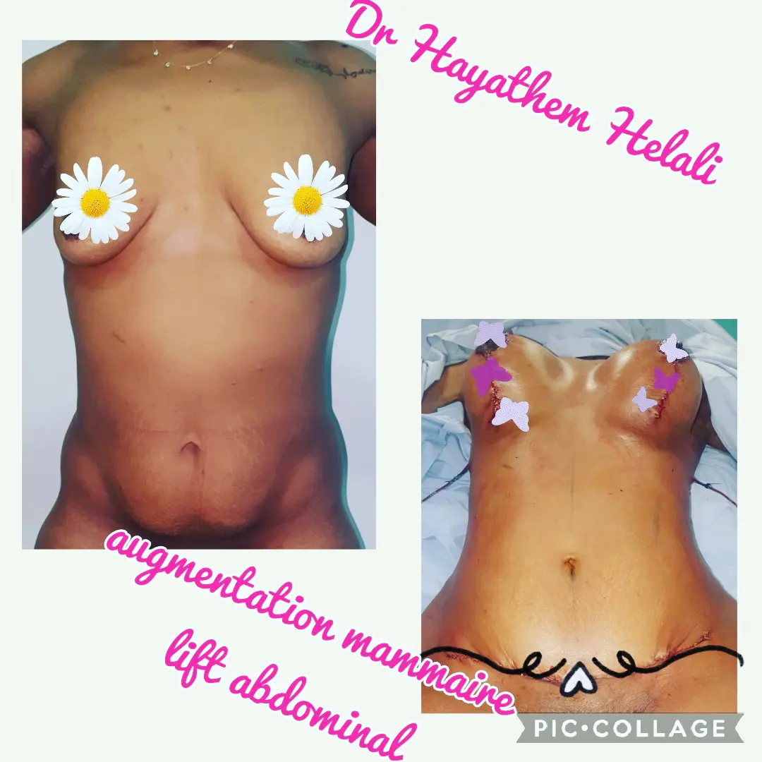 Cette image montre les résultats d'une augmentation mammaire et d'un lift abdominal.