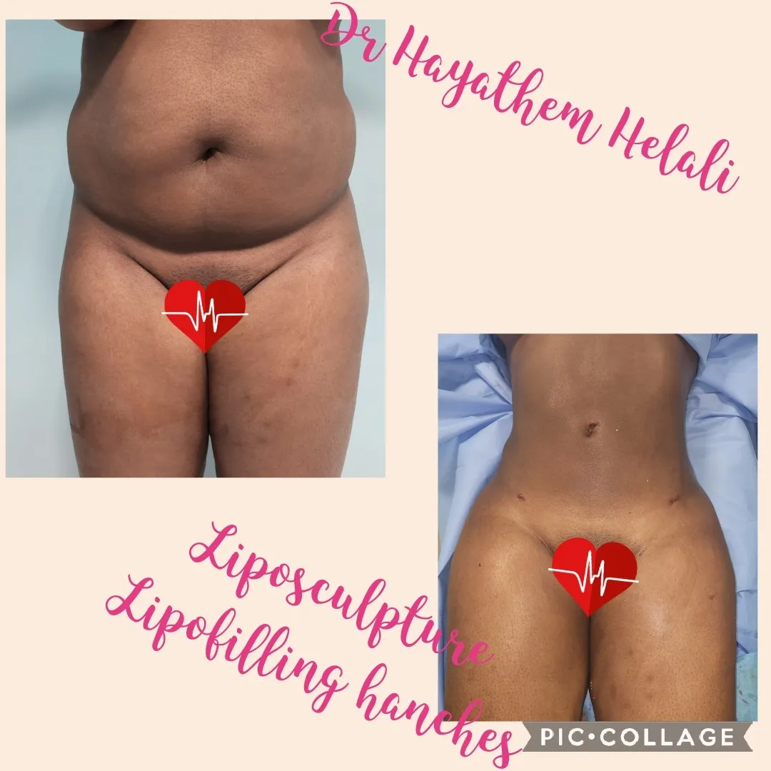 Photo avant/après d'une augmentation des fesses par lipofilling.