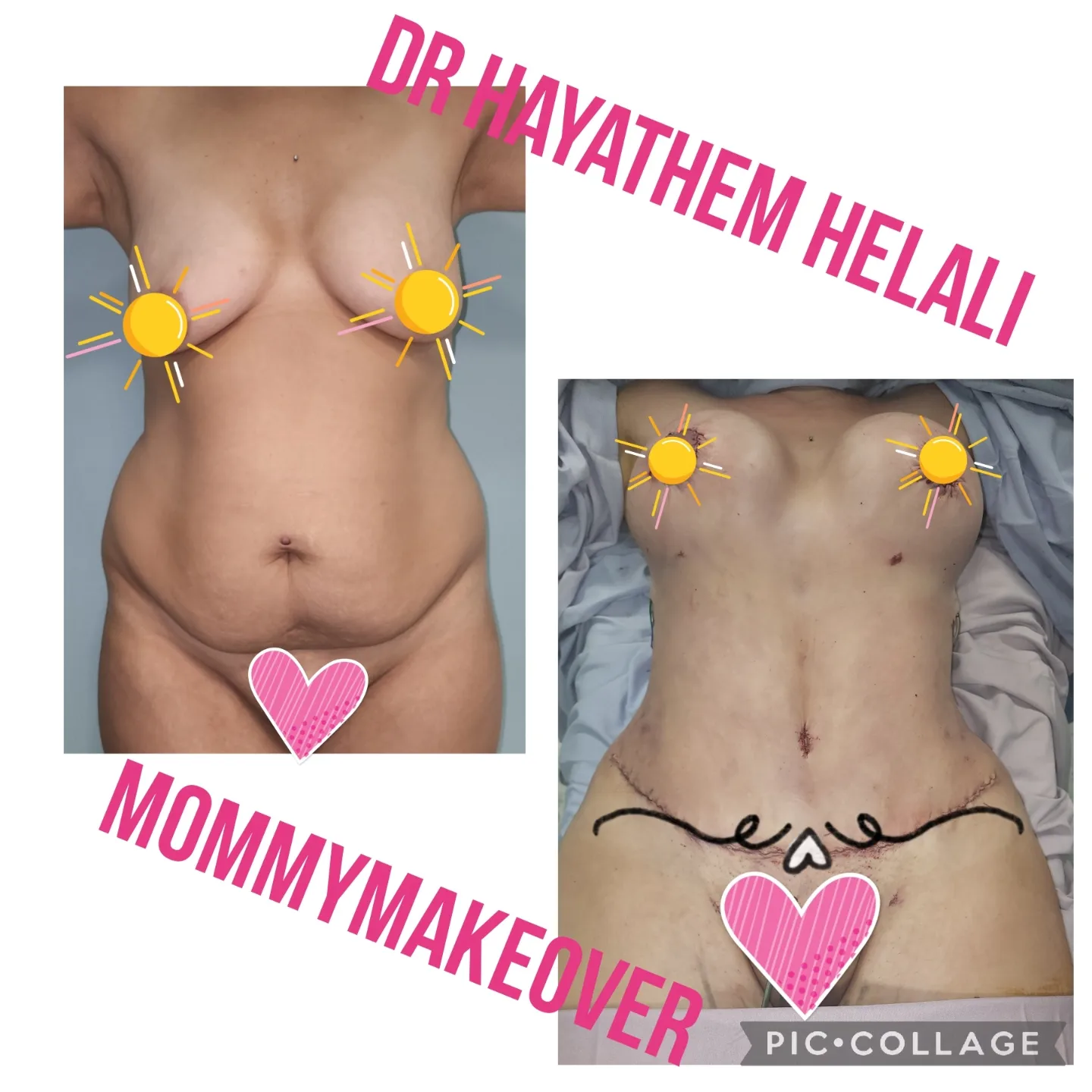 Avant et après une chirurgie de relooking maternel, incluant des implants mammaires et une abdominoplastie.
