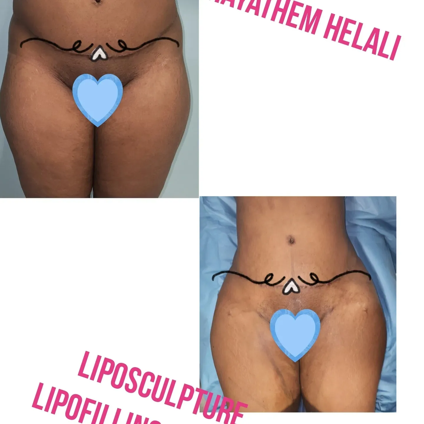 Ce post montre un avant/après d'une chirurgie d'augmentation des fesses par lipofilling.