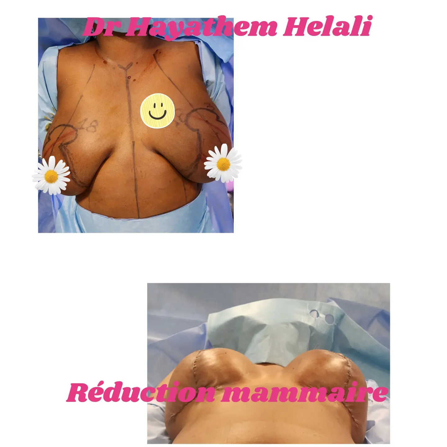 Comparaison avant et après une réduction mammaire pour soulager les douleurs dorsales et cervicales.