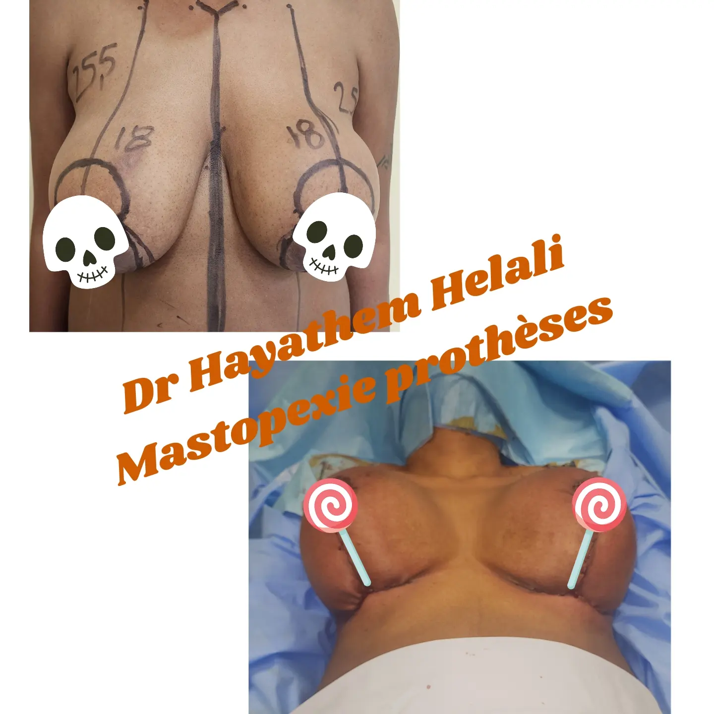 Avant et après la chirurgie de mastopexie avec prothèses mammaires.