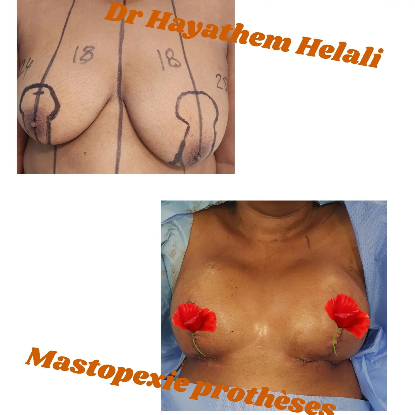 Post opératoire montrant une augmentation mammaire avec prothèses et mastopexie.