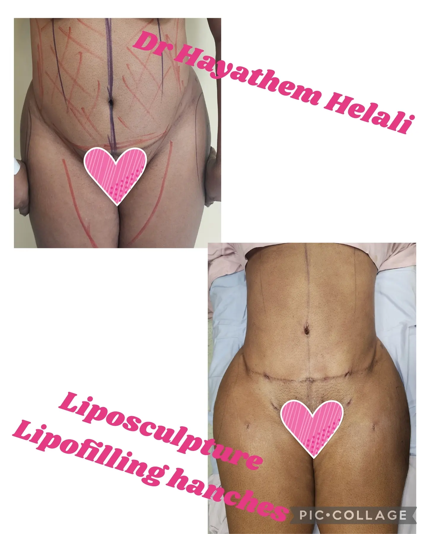 Avant et après une liposculpture et un lipofilling des hanches.
