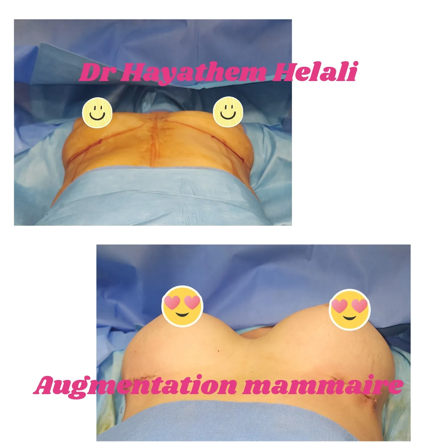 Augmentation mammaire avec prothèses rondes de 400cc chez une jeune patiente.