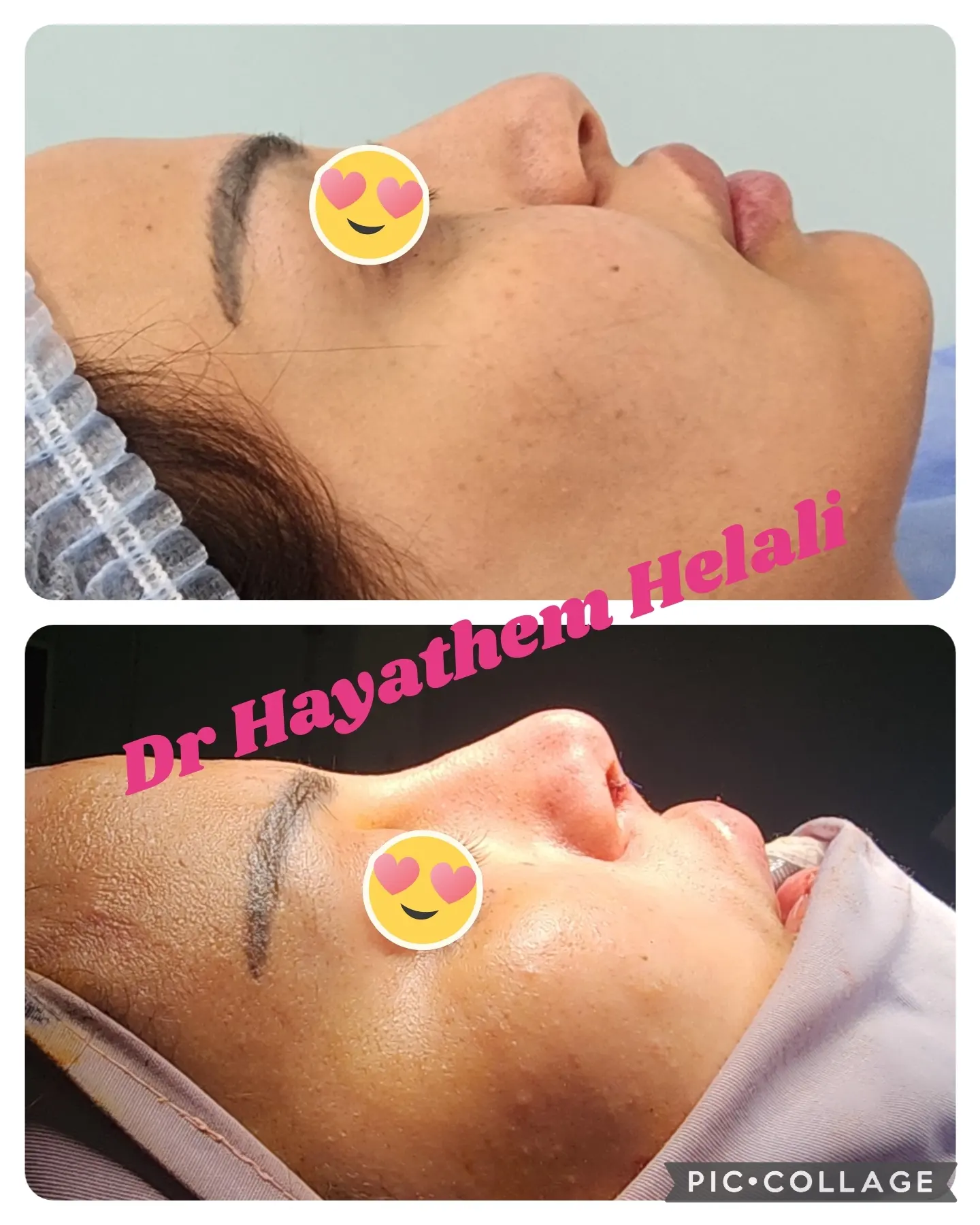 Comparaison avant et après une rhinoplastie réalisée par le Dr Hayathem Helali.
