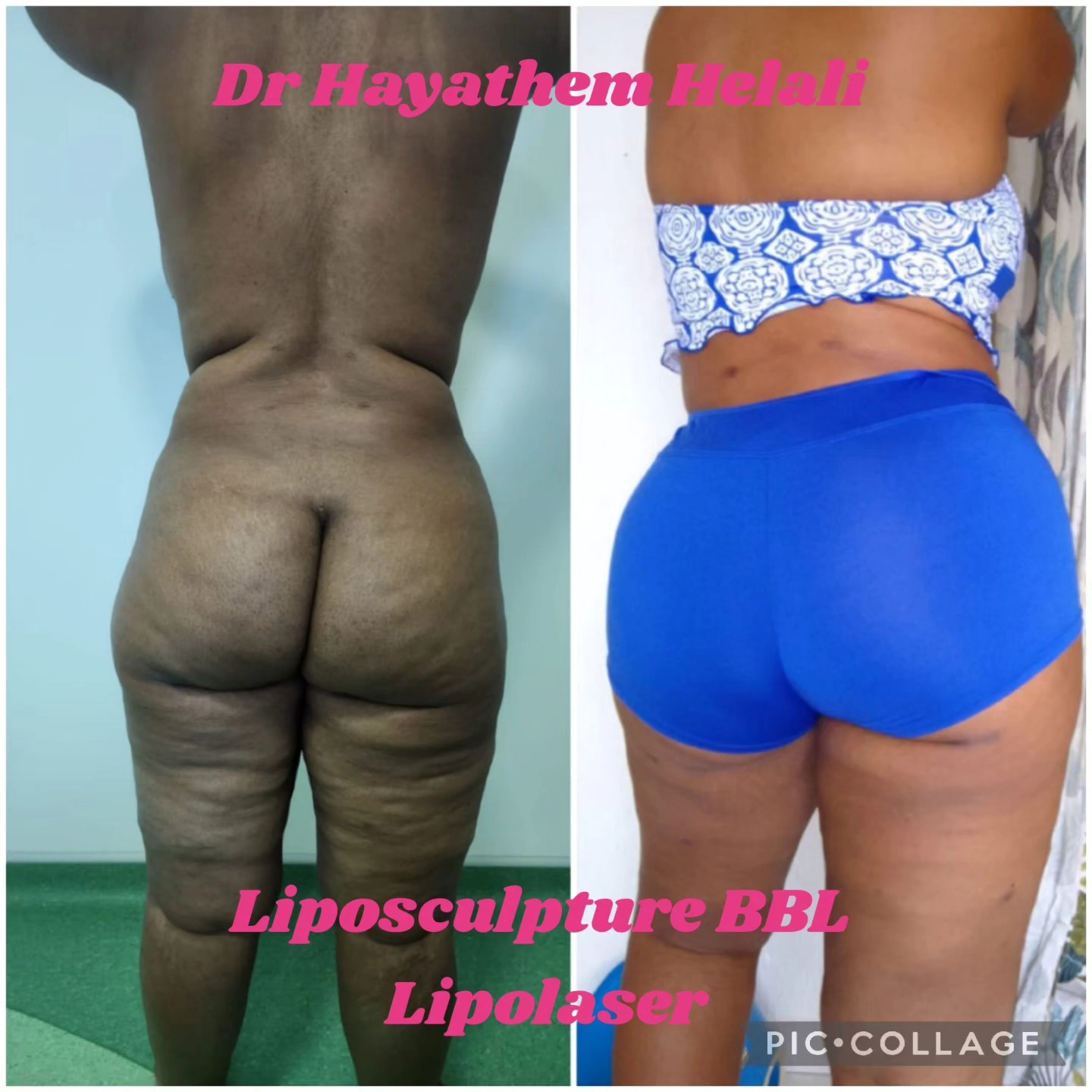 Résultat de liposculpture et BBL après deux mois de postopératoire montrant une amélioration de l'aspect de la cellulite.