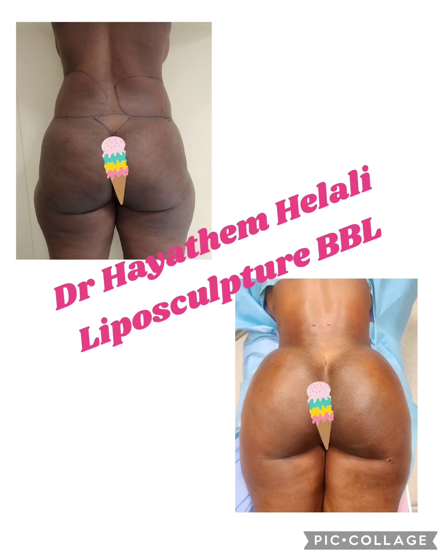 Ce post montre une comparaison avant et après l'augmentation de fesses par liposculpture.
