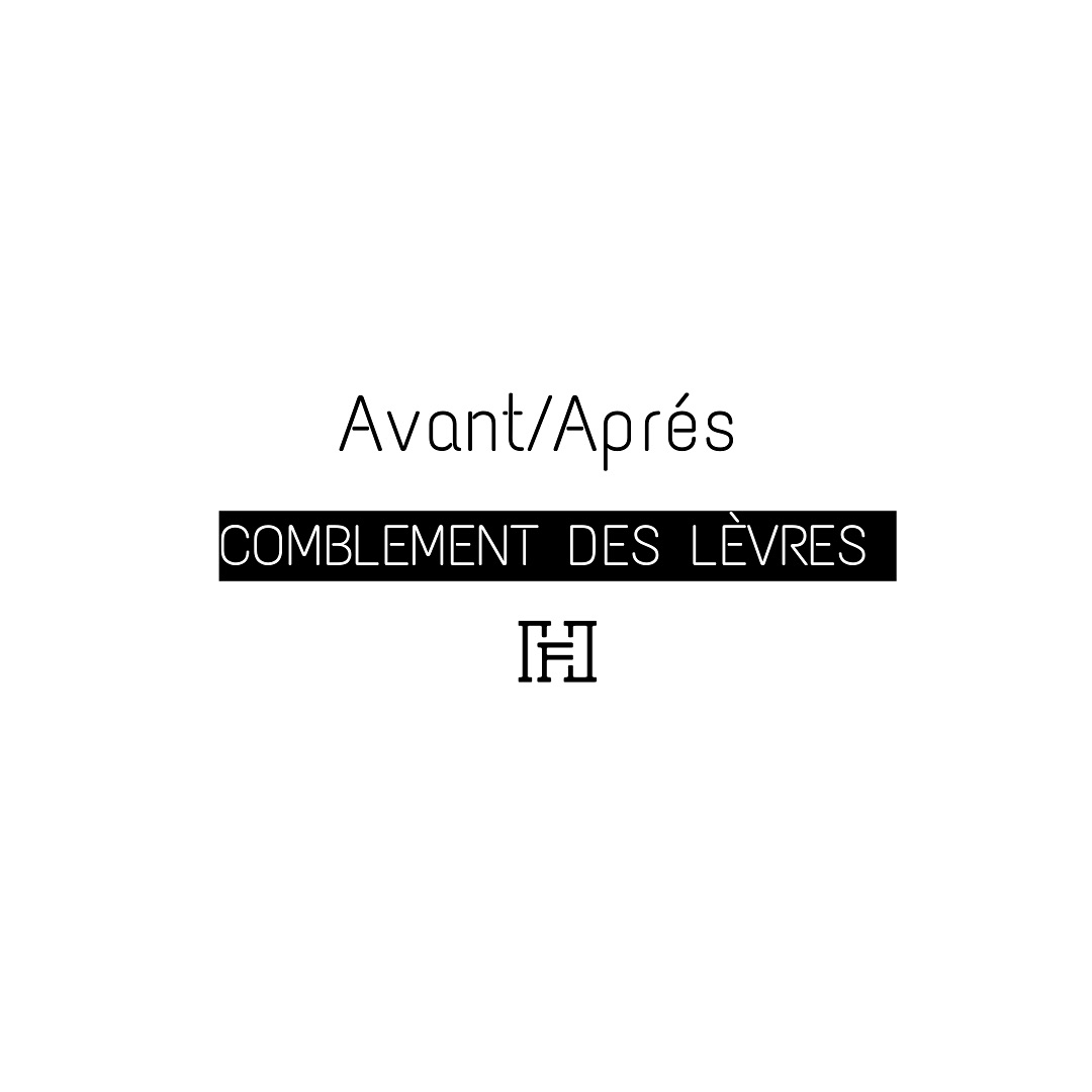 Le comblement des lèvres par acide hyaluronique offre une augmentation du volume et un meilleur contour des lèvres.