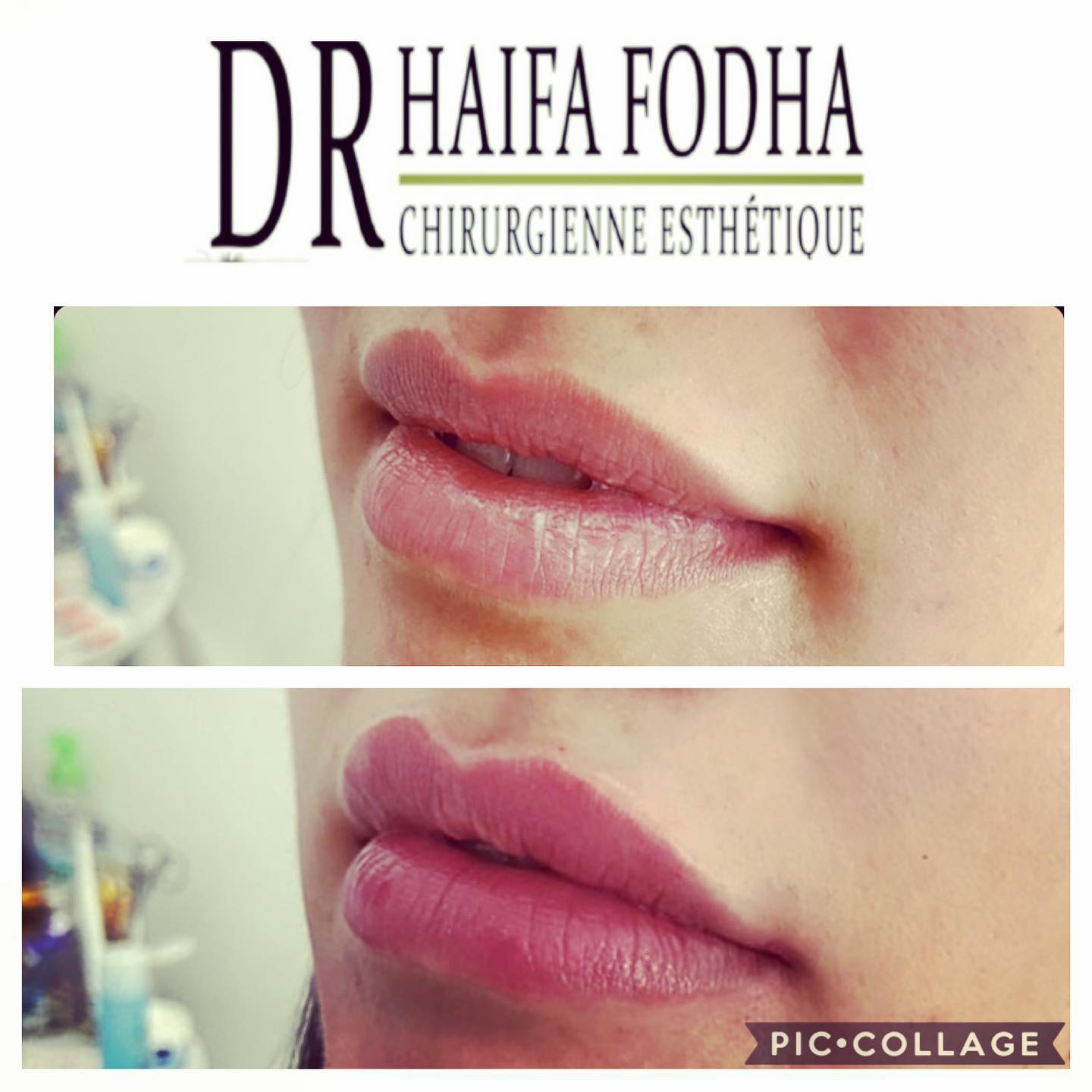 Le comblement des lèvres avec de l'acide hyaluronique pour volume et hydratation est illustré par cette comparaison avant/après.