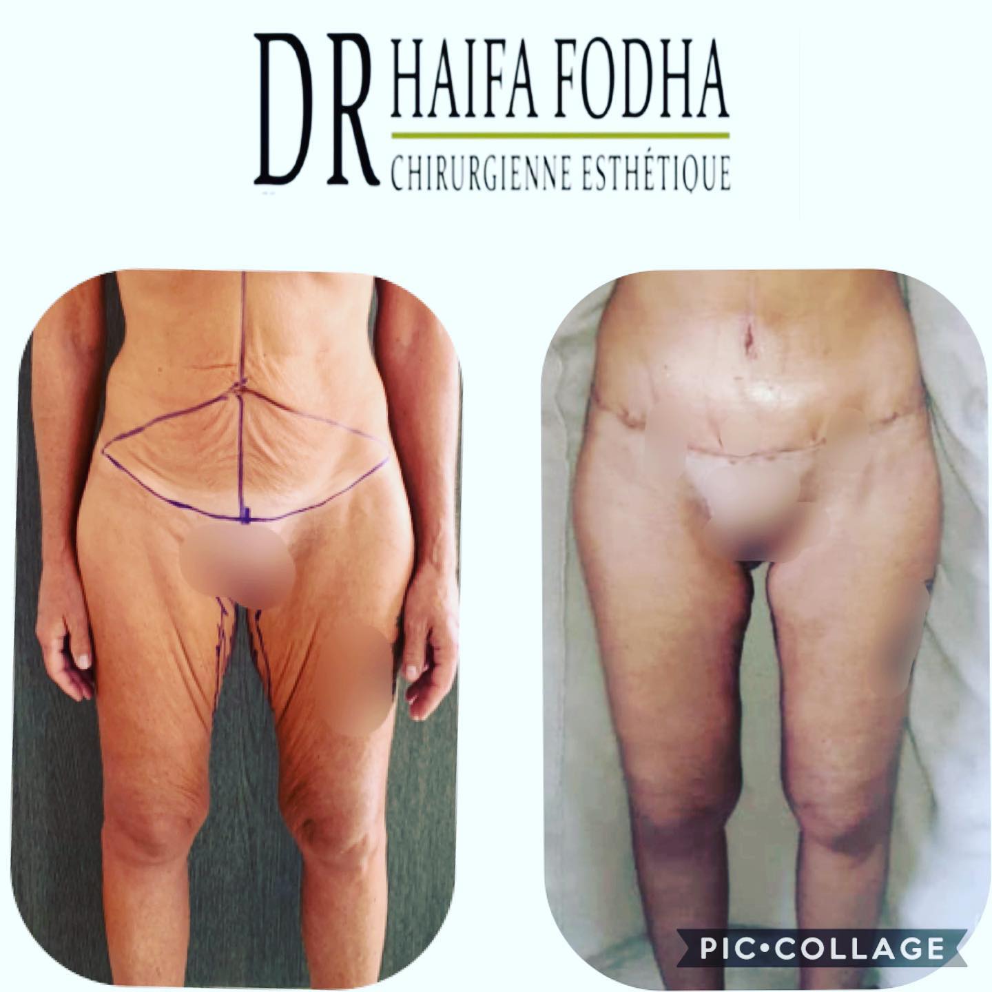 Cette publication présente des résultats d'une plastie abdominale et d'un lifting des cuisses après une perte de poids importante.