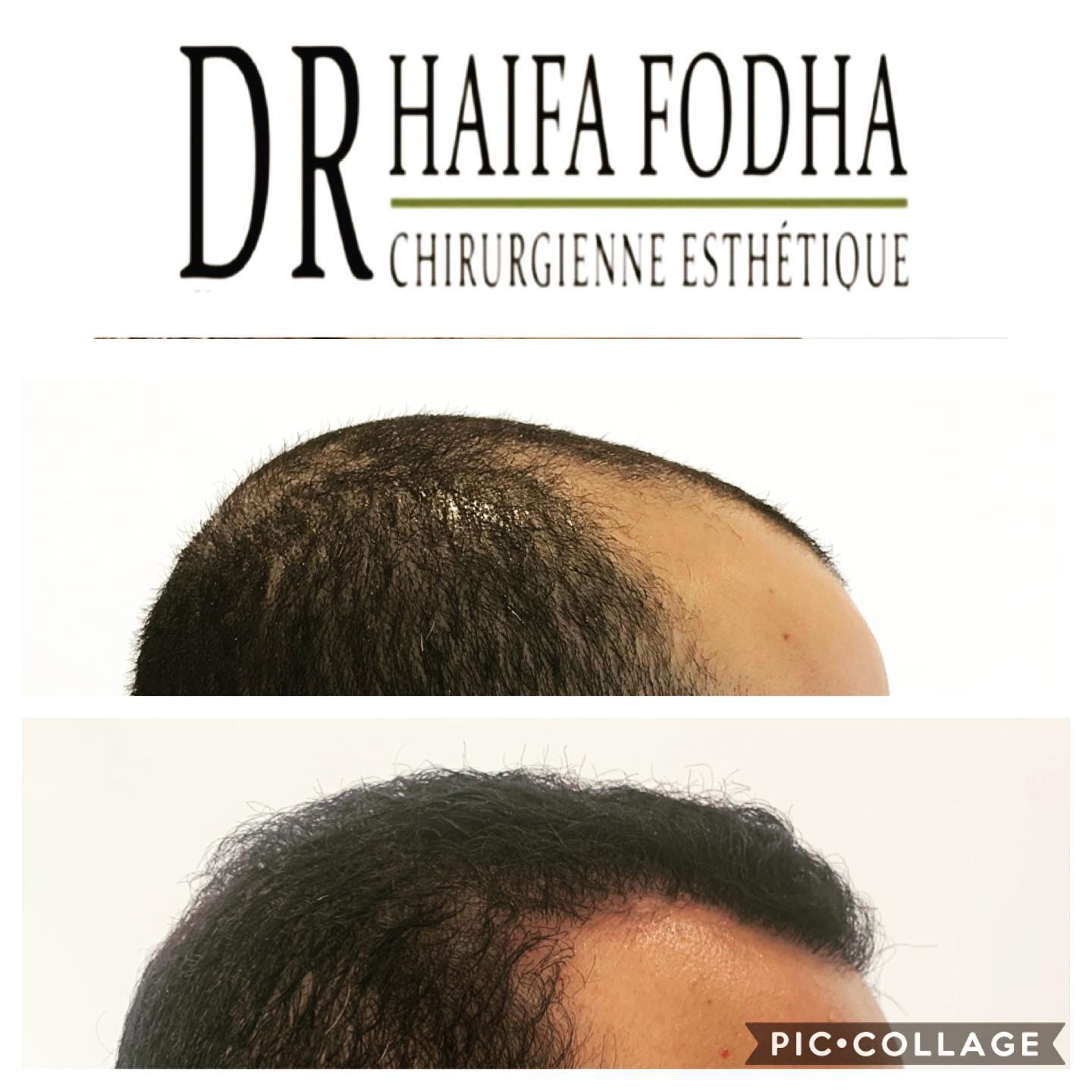 Cette publication présente le résultat d'une greffe de cheveux après la première intervention.