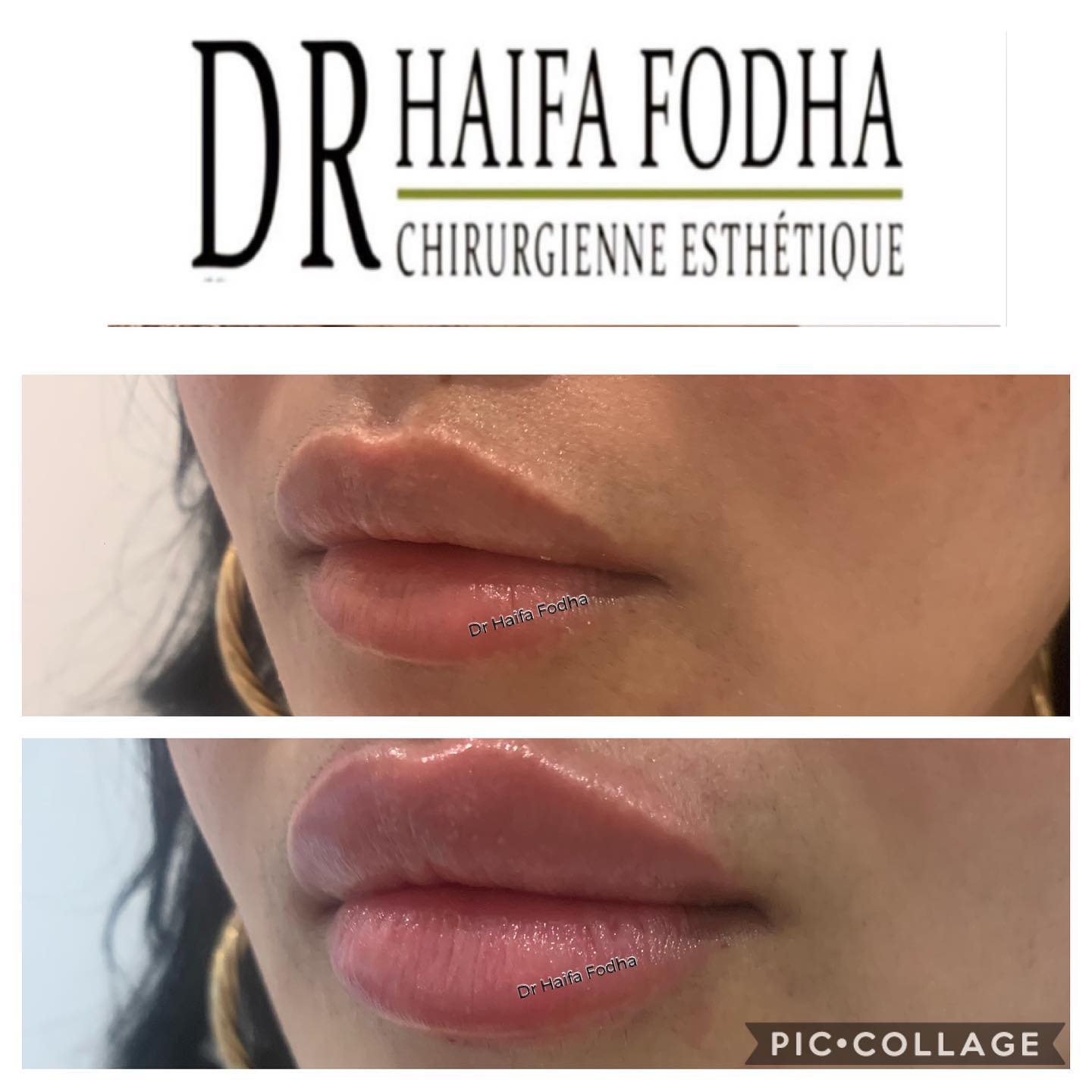 Ce post présente un résultat de comblement des lèvres avec acide hyaluronique.
