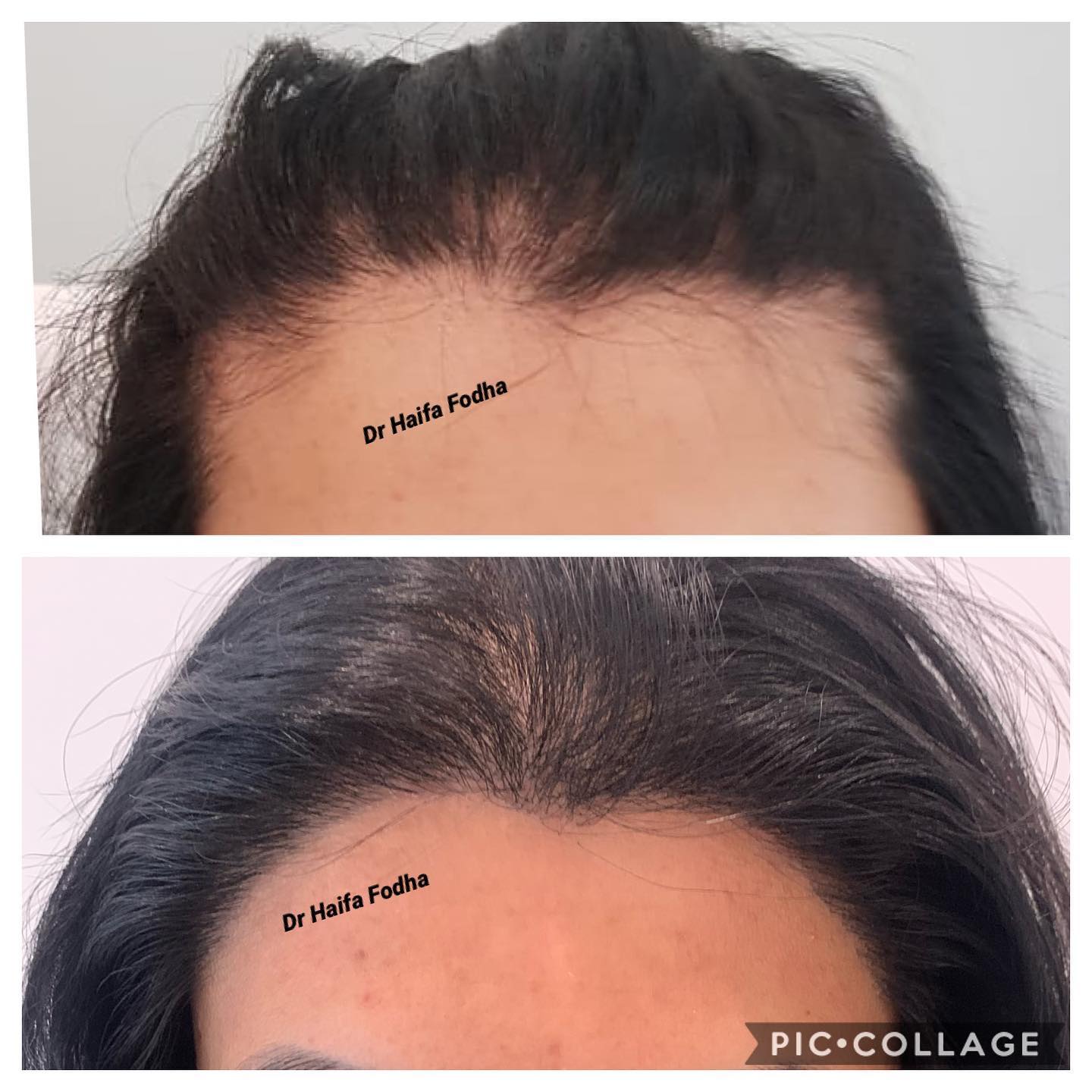 Cette publication montre des résultats de greffe de cheveux, avec des informations sur le processus.