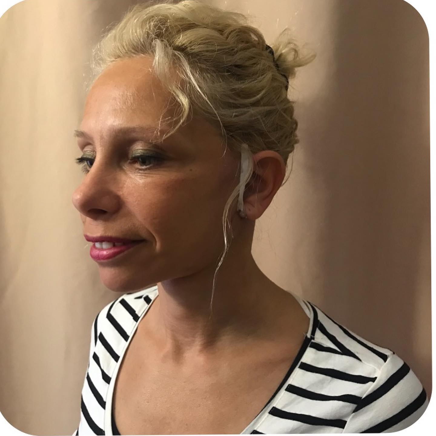 Photo d'une patiente après un lifting cervico-facial, montrant les résultats postopératoires.