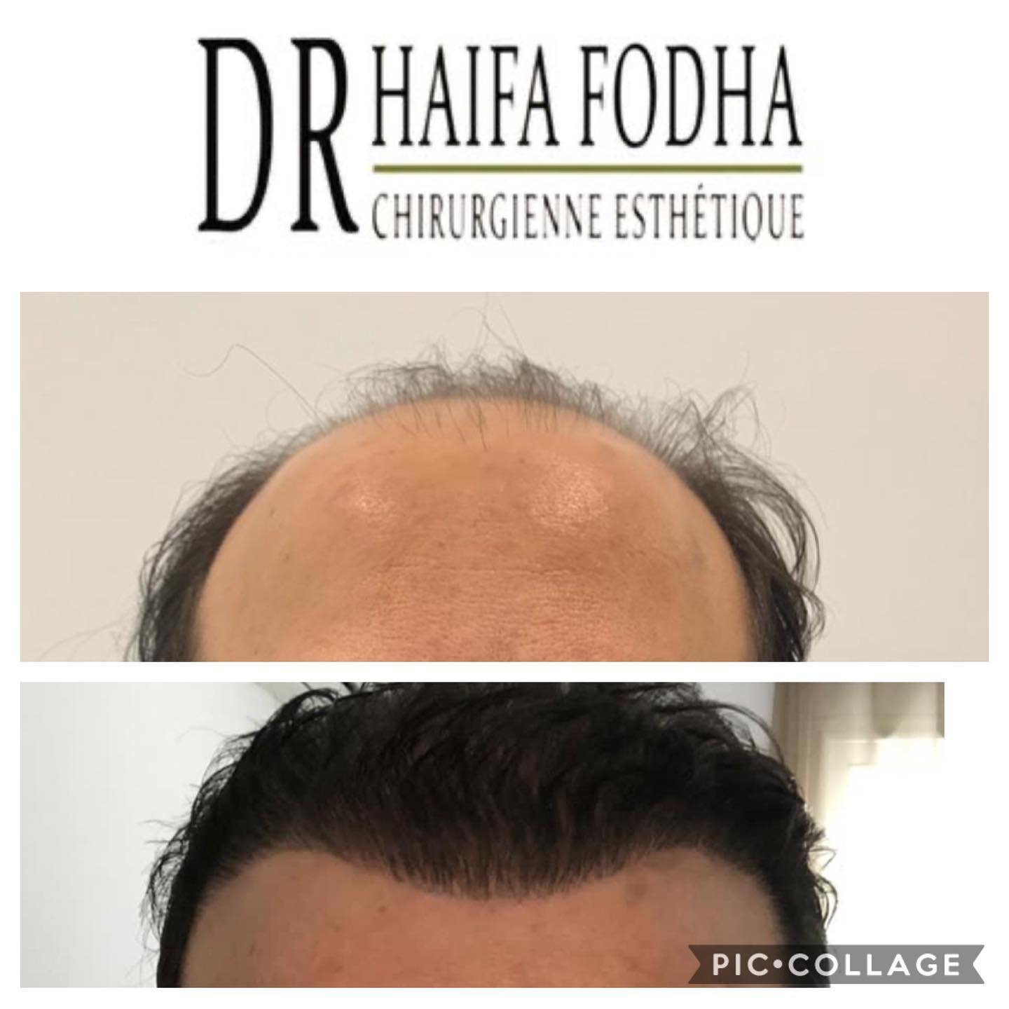 Cette publication montre les résultats d'une greffe de cheveux effectuée sur un patient.