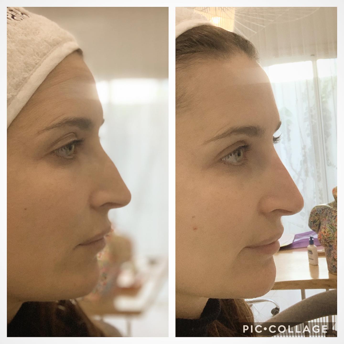 Cette publication illustre une rhinoplastie médicale via des injections de comblement.