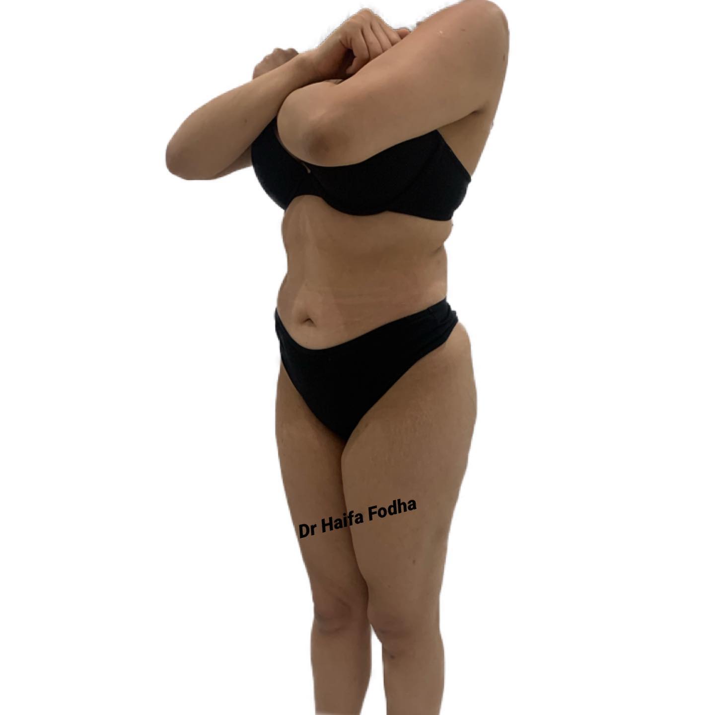 Cette intervention comprend une plastie abdominale et une lipoaspiration combinée avec un lipofilling des fesses.