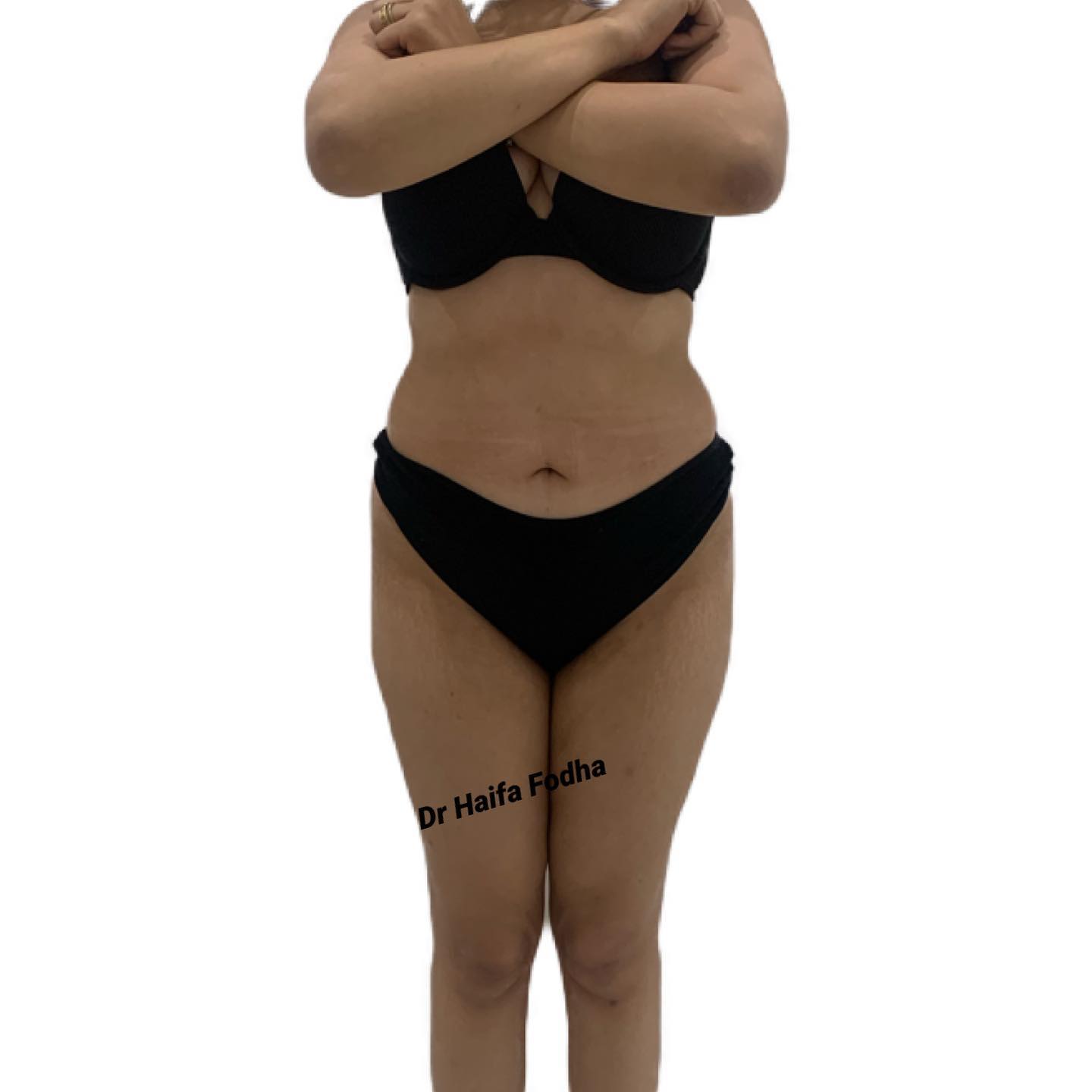 Cette jeune femme a subi une plastie abdominale et une lipoaspiration avec lipofilling des fesses.