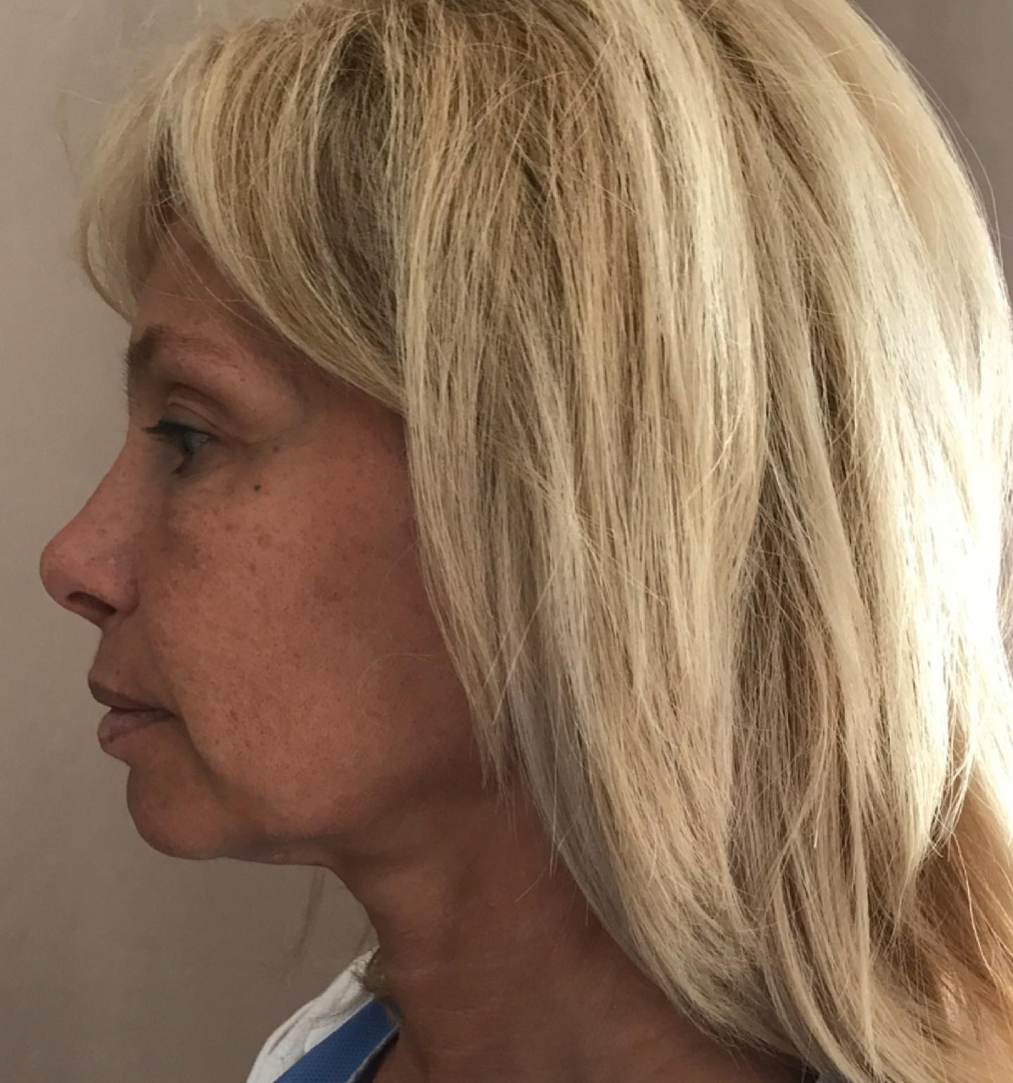 Cette image montre une patiente le jour de son intervention de lifting cervico-facial.