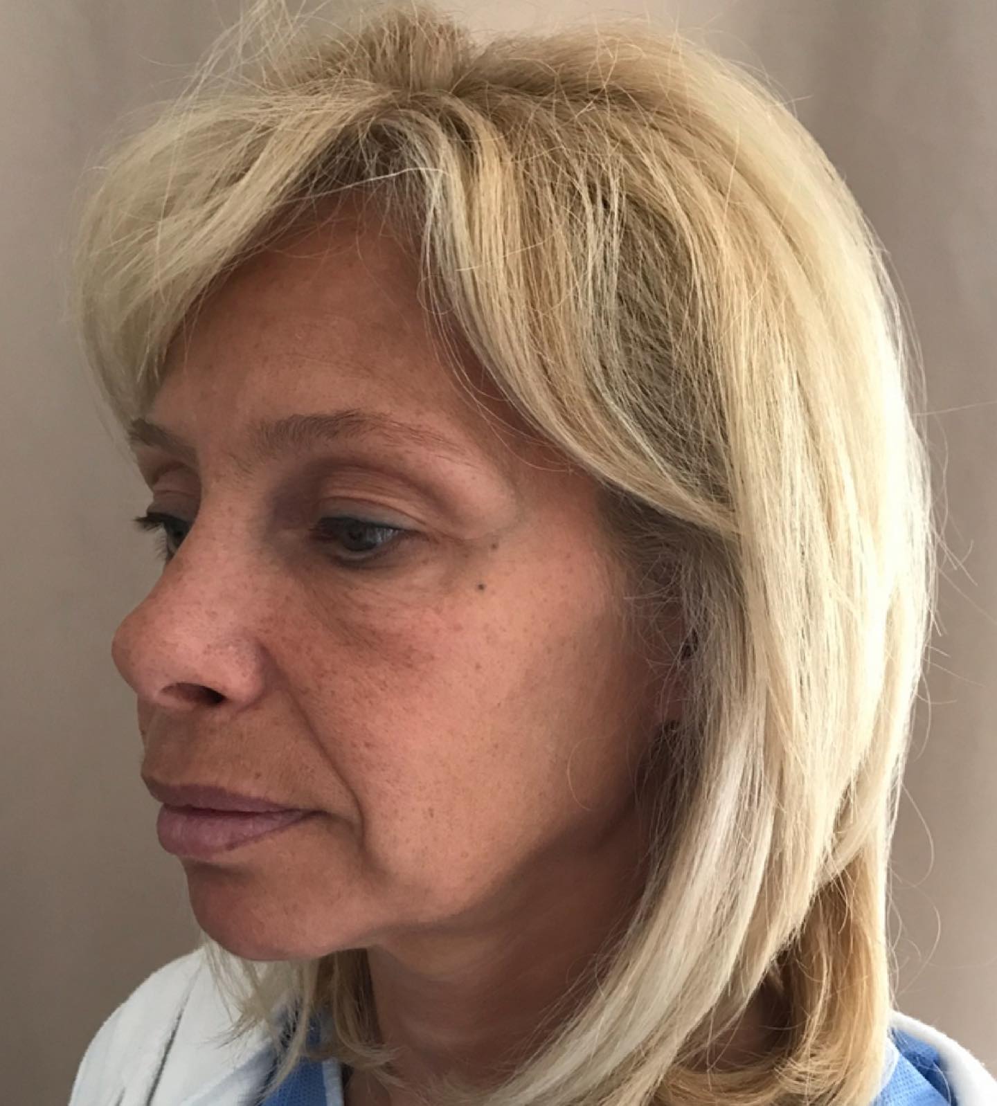 Le lifting cervico-facial est une intervention visant à rajeunir le visage et le cou.