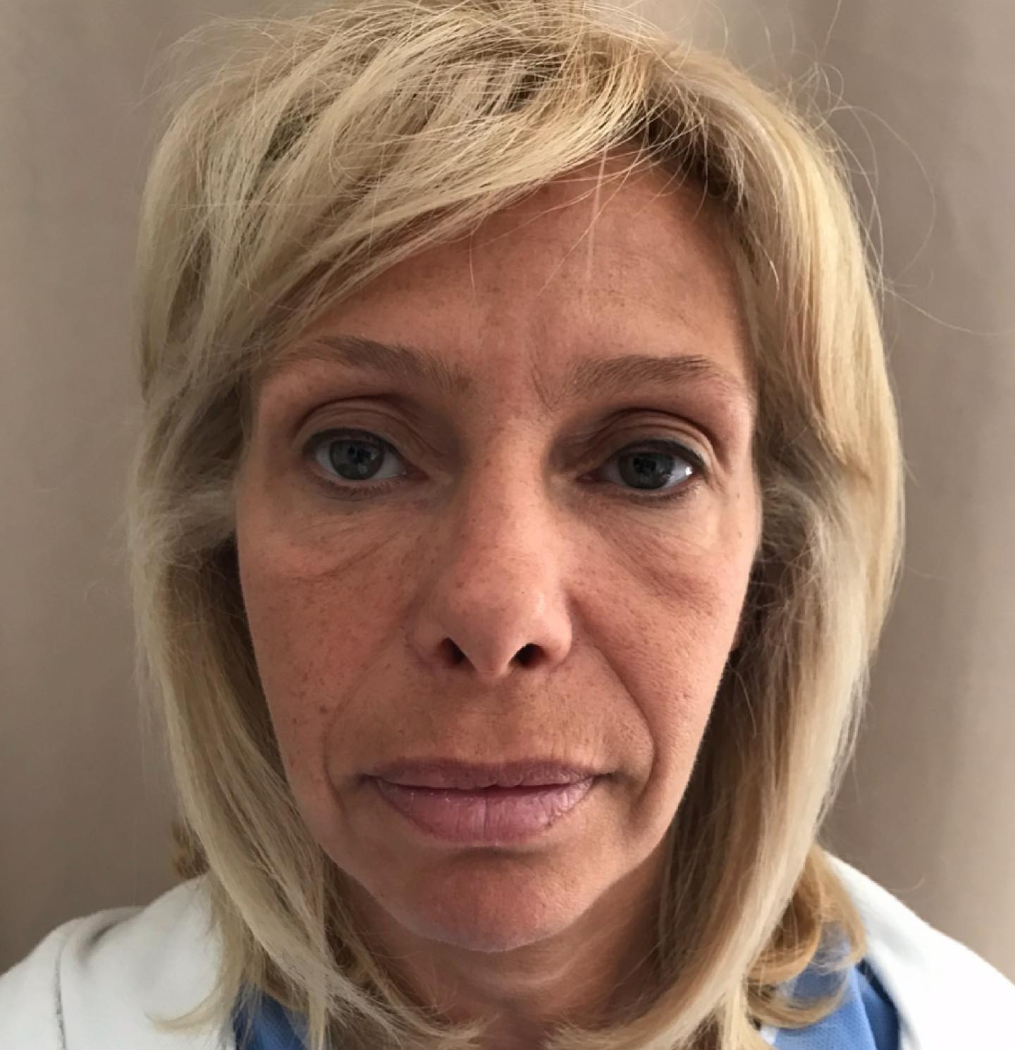 Cette photo montre une patiente le jour de son intervention de lifting cervico-facial.