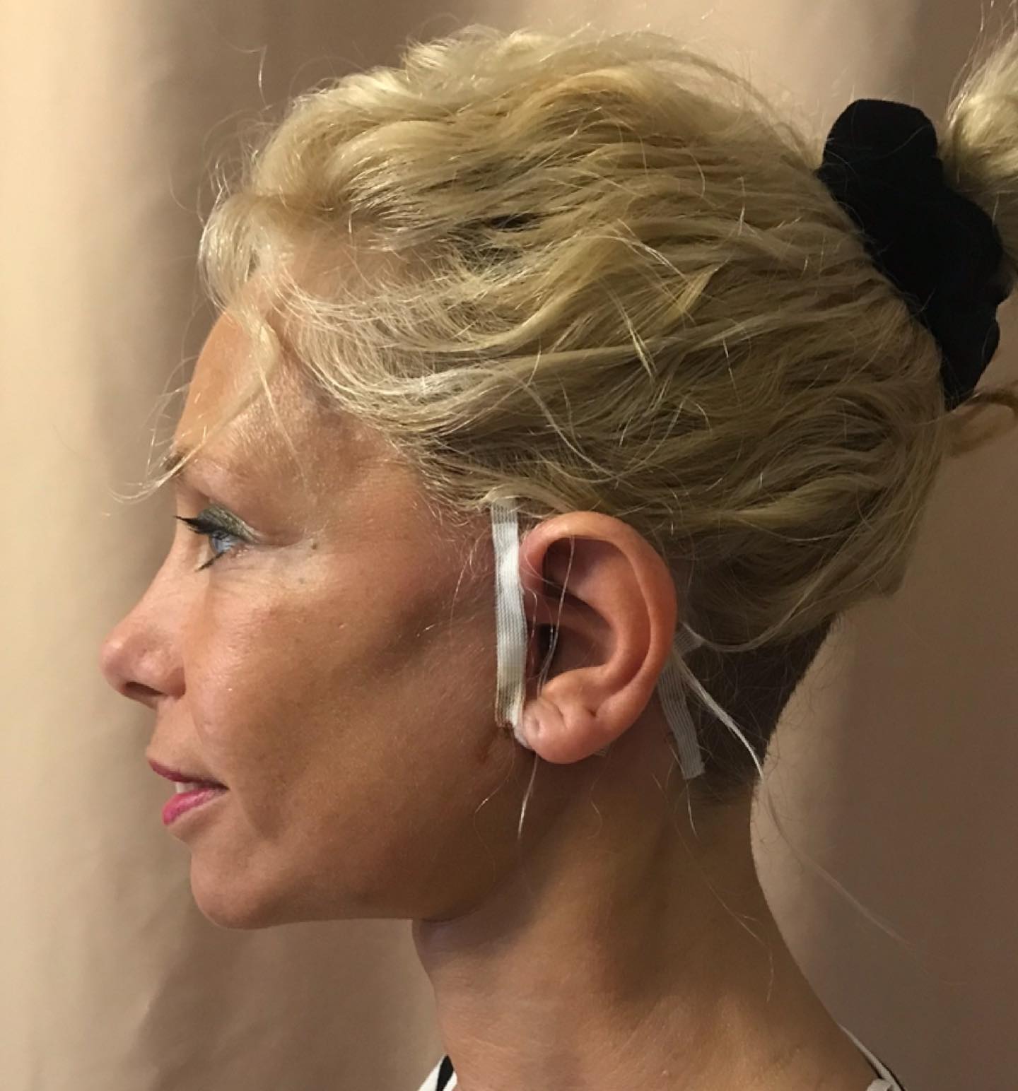 Photo d'une patiente ayant subi un lifting cervico-facial, avec explication sur les résultats attendus.