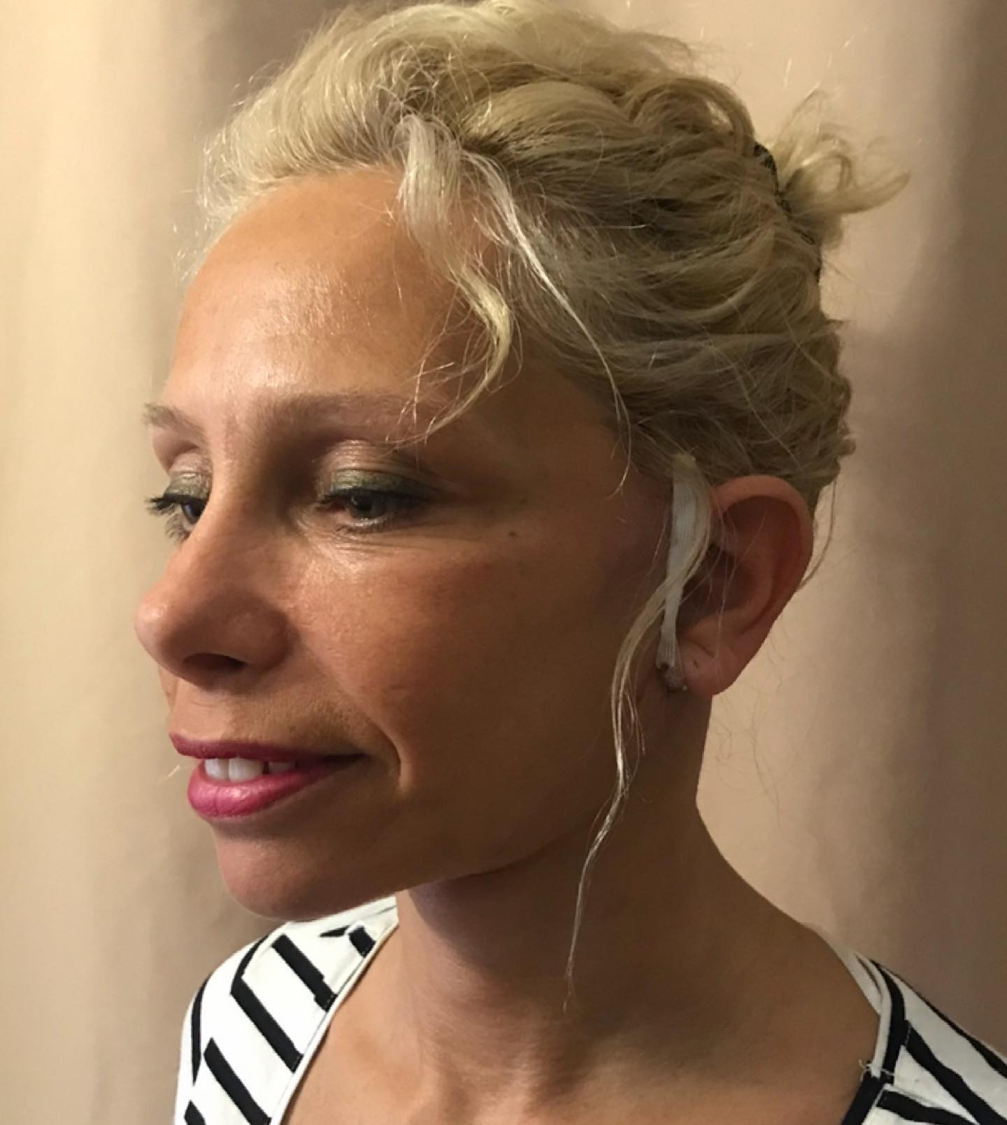 L'image montre une patiente le lendemain d'un lifting cervico-facial, une procédure de rajeunissement du visage et du cou.