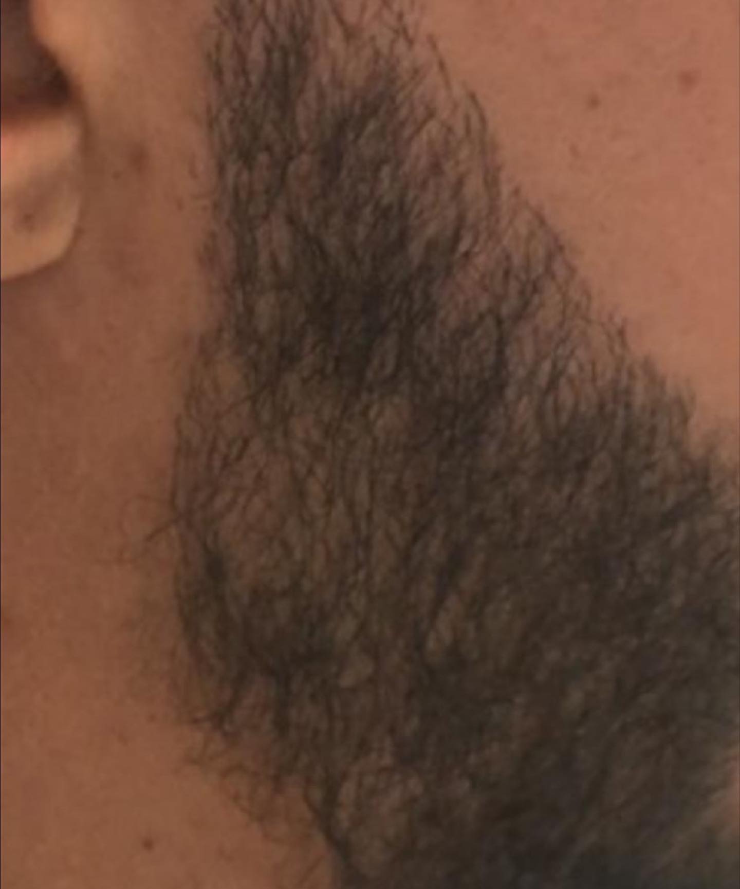 Ce post fournit des informations sur la greffe de barbe, soulignant son efficacité et les résultats possibles.