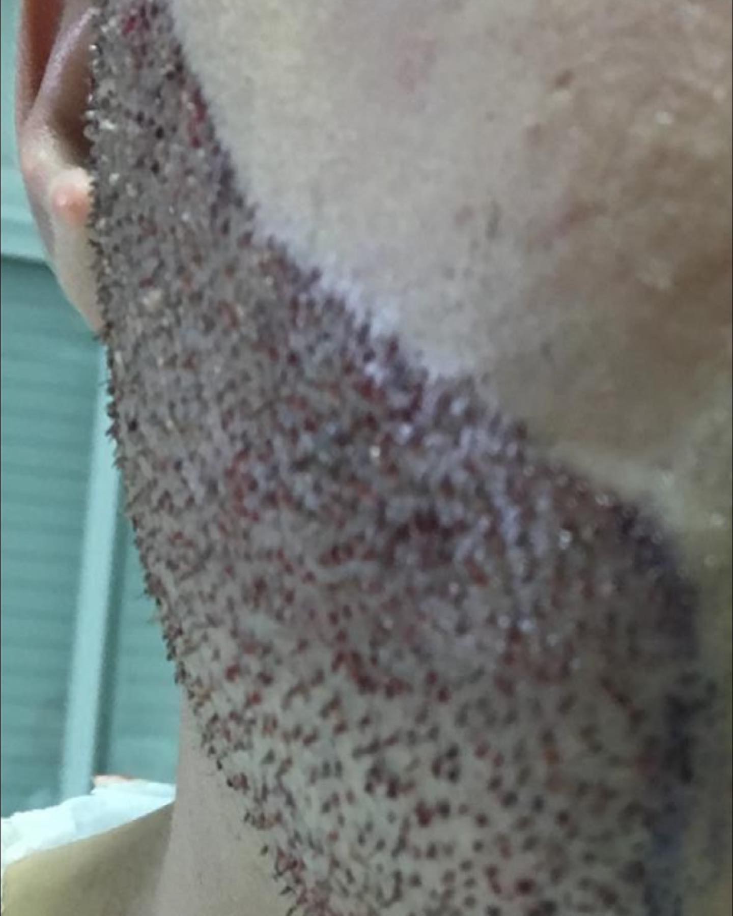 Cette publication fournit des informations sur la greffe de barbe, soulignant son efficacité.