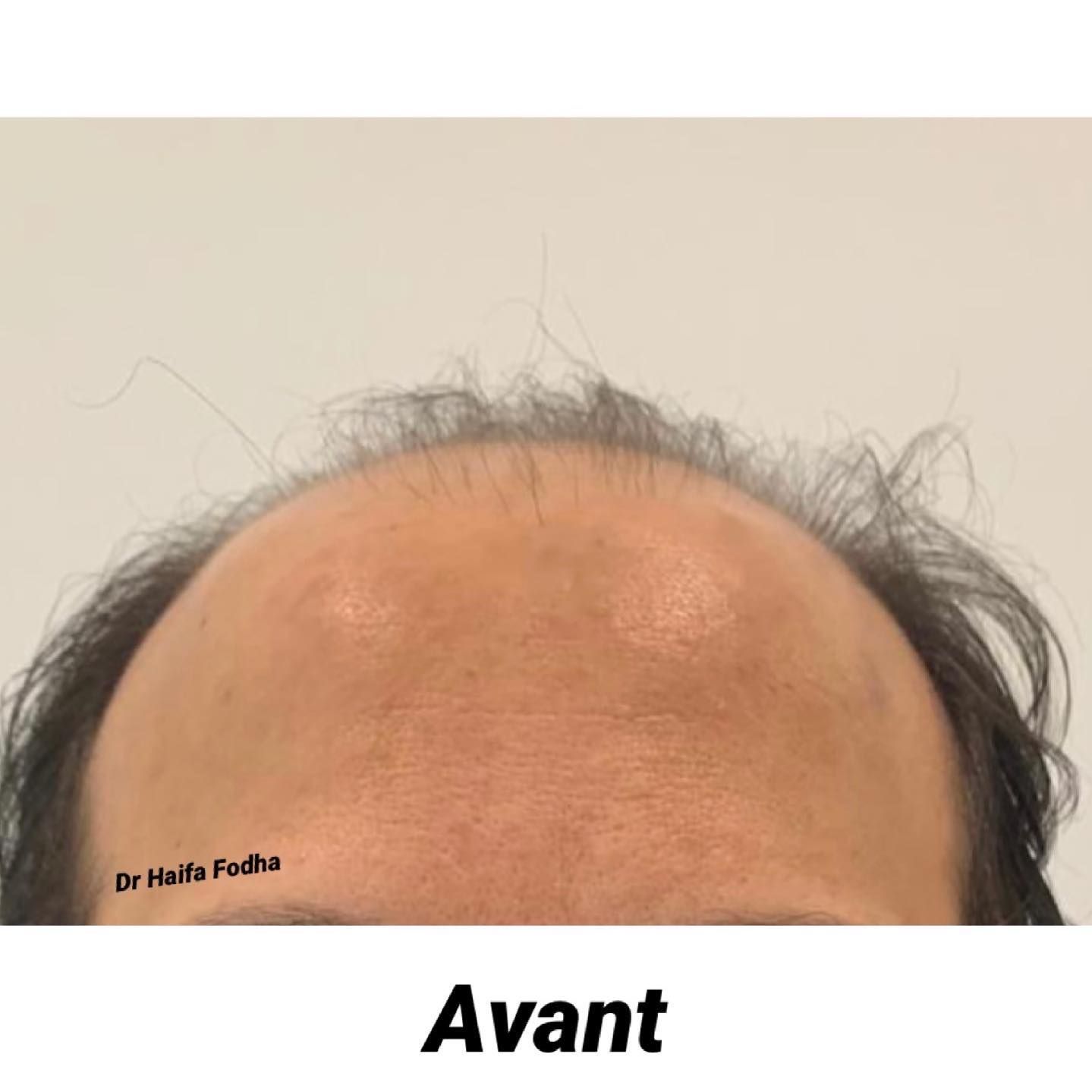 Une greffe de cheveux est une intervention effectuée en quelques heures, avec un résultat définitif attendu après 12 mois.
