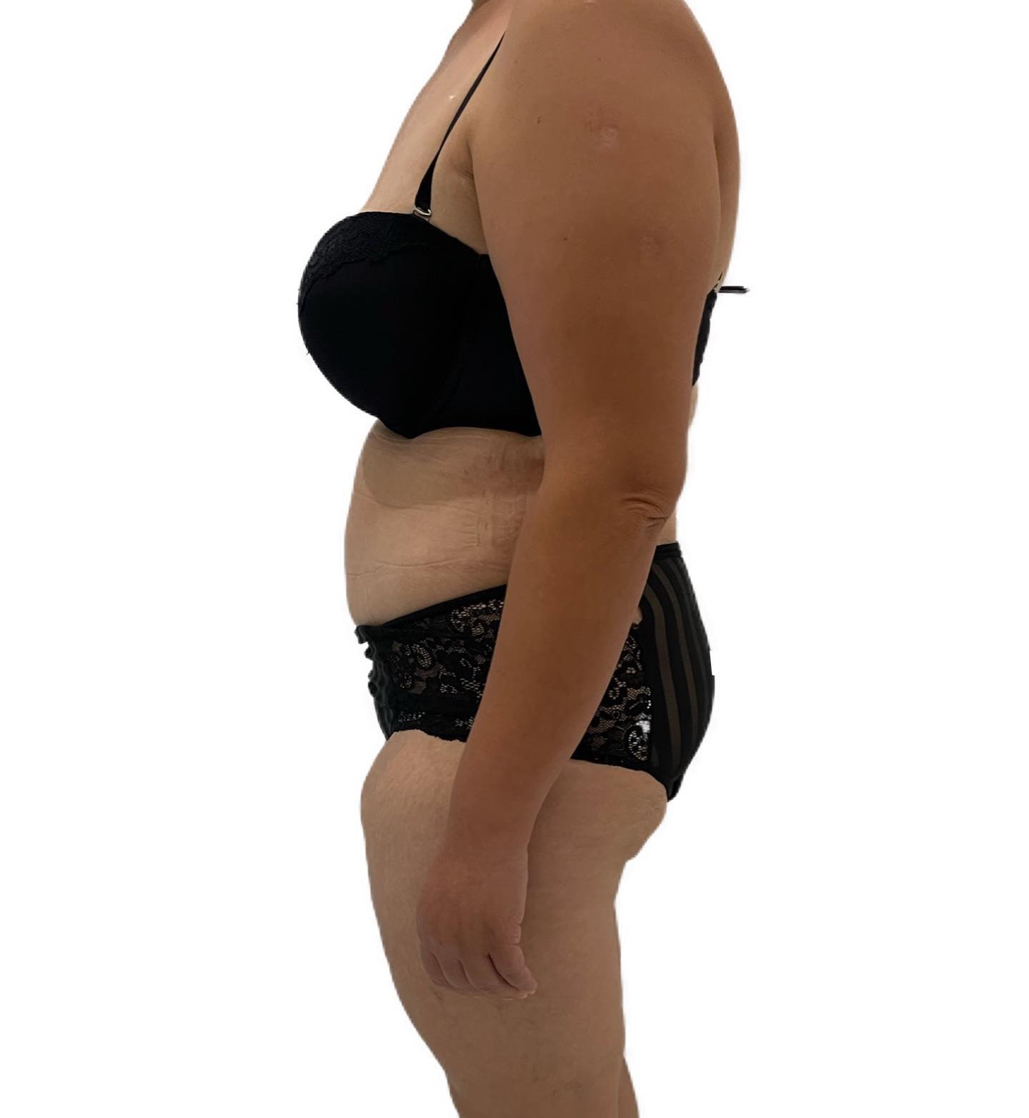 Cette patiente a subi une plastie abdominale après une perte de poids significative.