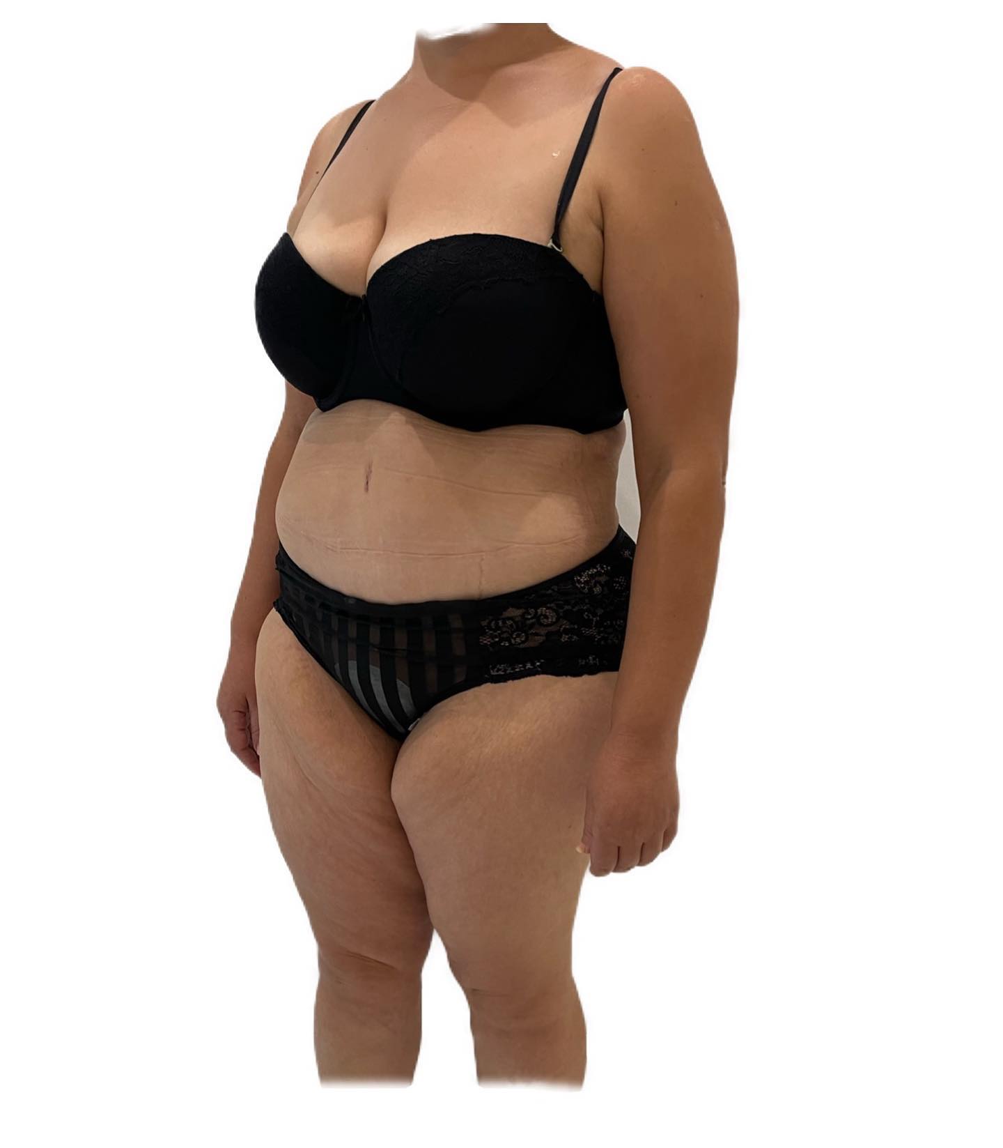 Cette post présente les résultats d'une plastie abdominale après une perte de poids significative.