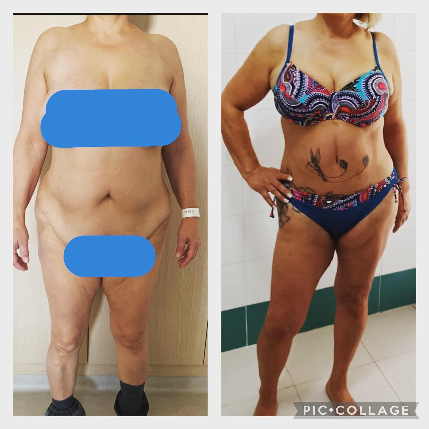 La plastie abdominale est une chirurgie visant à enlever l'excès de peau et de graisse au niveau du ventre.